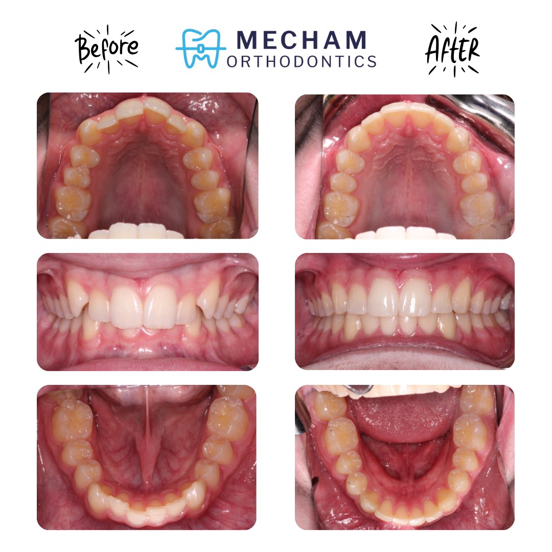 What a result 🔥
21 months, great compliance, and staying consistent with rubber bands made this transformation happen. This is what braces + commitment can do 🙌
Ready to see what’s possible for your smile? Give us a call or send us a message to get started 🦷💙
#MechamOrtho #MechamOrthodontics #Braces #TeenBraces #BeforeAndAfter #SmileTransformation #Orthodontics #SmileGoals