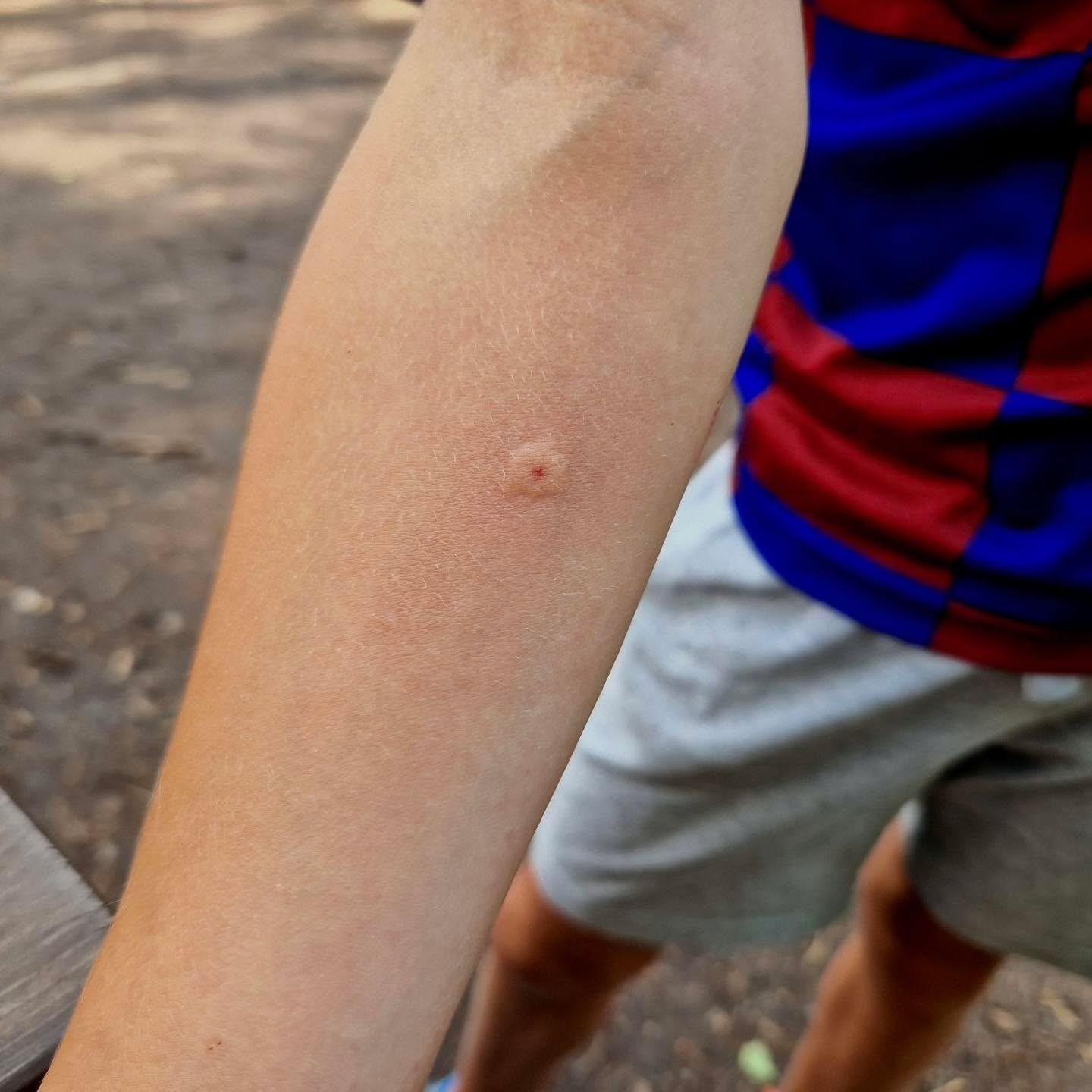 💙 Insect bites after a day in the garden? Here’s what to do
Spending time outside is great… but bites and stings can happen.
For most insect bites:
• Wash the area with soap and water
• Apply a cold compress to reduce swelling
• Try not to scratch, as this can lead to infection
If there’s a visible sting (like from a bee), gently scrape it away rather than squeezing it.
Watch for signs of a more serious reaction:
• Difficulty breathing
• Swelling of the face or throat
• Feeling dizzy or faint
If any of these happen, call 999 / 112 immediately.
Most bites are minor, but knowing what to look for really matters.
DTMK Training Services
🌐 https://training.dtmk.co.uk
📞 01908 112111
📧 enquiries@dtmk.co.uk
#BystandersToLifesavers #NobodyLeftWithoutCare #PreparedPeople #SaferWorkplaces #StrongerFamilies #DTMK #FirstAid #FirstAidTraining #MiltonKeynes #Buckinghamshire #Bedfordshire #Northamptonshire #Oxfordshire