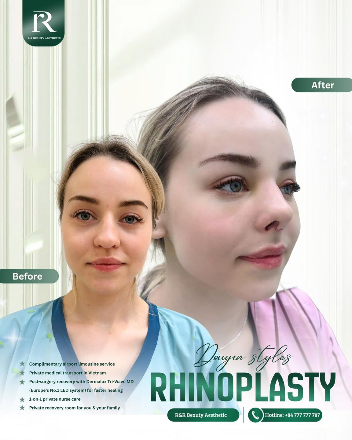 With Douyin-style rhinoplasty, the goal isn’t to create a “new face,”
but to refine the nose so it fits naturally with your features.
🔥 A more refined and balanced nose shape
🔥 Softer, more harmonious facial proportions
🔥 A smoother profile from every angle
🔥 Natural-looking results that don’t appear overdone
DM us to book your consultation
Limited appointments available each day
.
.
.
#rhinoplasty #nosecontouring #douyinstyle #facialharmony #naturalresults
douyin rhinoplasty
natural nose shape
nose contour result
before after rhinoplasty
harmonious face
confidence after rhinoplasty