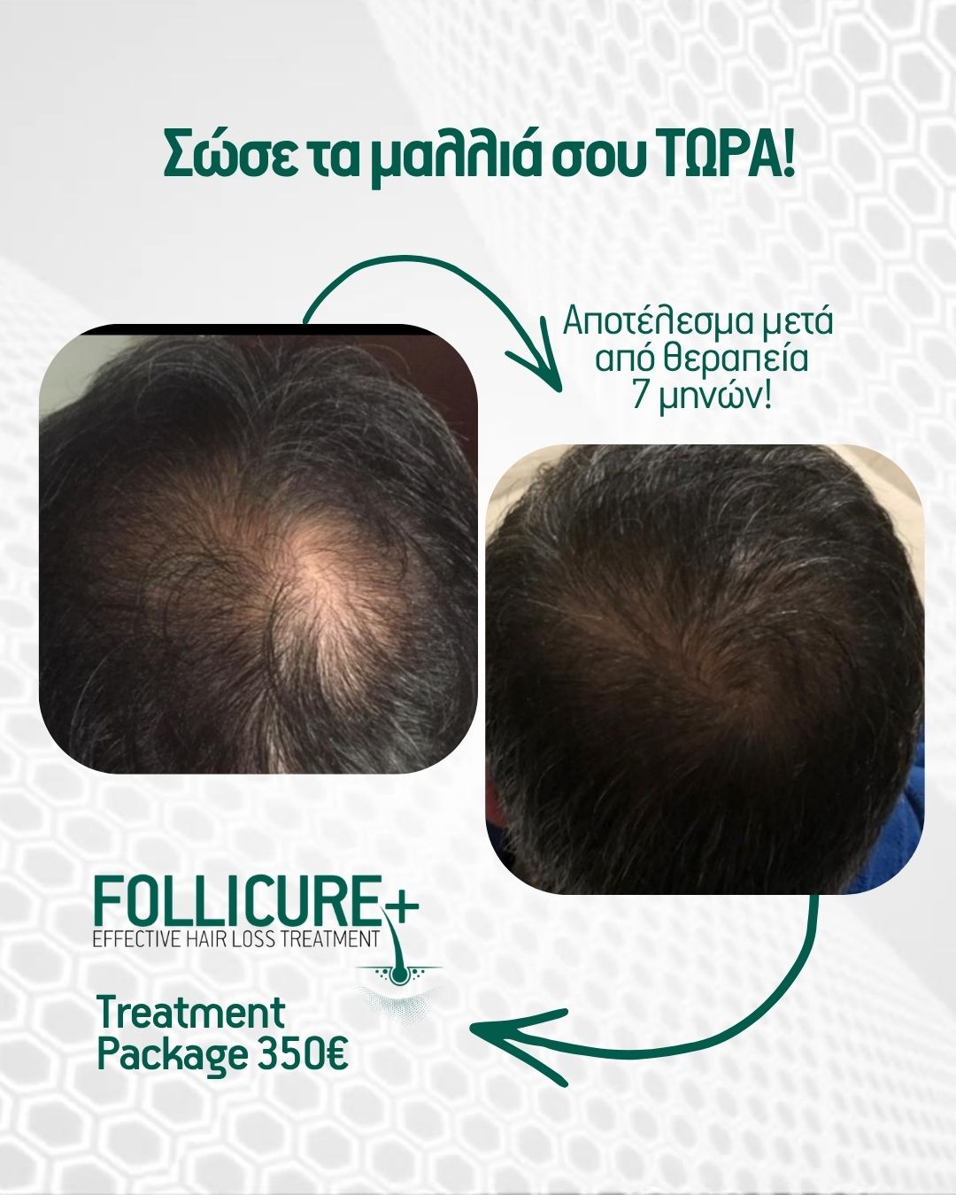 Η θεραπεία FOLLICURE+ by @stefanos_goudelas σχεδιάστηκε για να δώσει νέα ζωή στο τριχωτό σου, ενισχύοντας τη φυσική αναγέννηση της τρίχας και βελτιώνοντας την υγεία της. Με εξατομικευμένη ιατρική αξιολόγηση, το FOLLICURE+ προσφέρει μια λύση που φέρνει μακροπρόθεσμα και ουσιαστικά αποτελέσματα