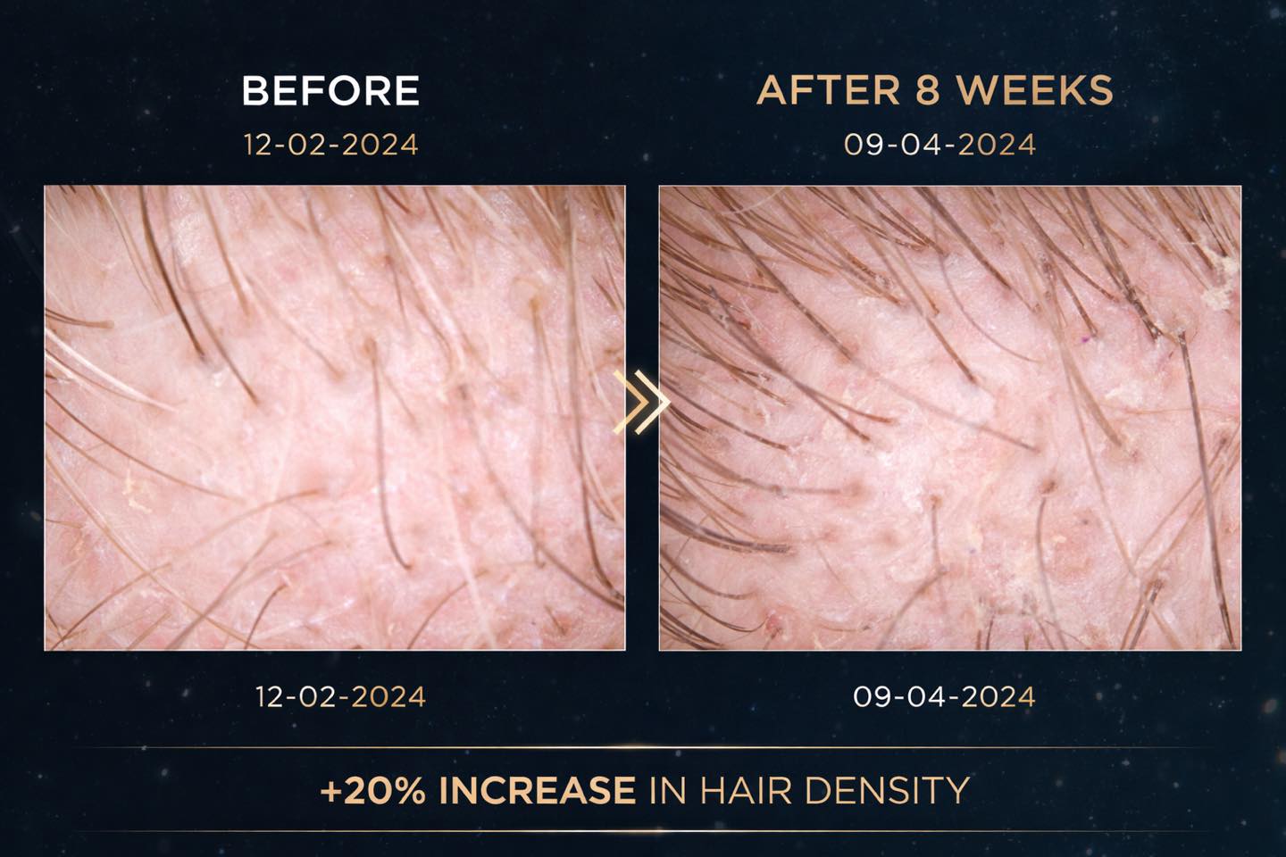 8 WEEK UPDATE – REAL SALON RESULTS
This is Anthony’s latest scalp analysis (09/04/2026) — now 8 weeks into his GLOWWA journey and 4 weeks since his last scan.
Again, these are not brand marketing images.
These are real results recorded in salon using professional Kérastase K-Scan technology to track Anthony’s progress over time.
⸻
So what’s changed since the last scan?
✔ Continued new hair growth coming through
✔ More consistent follicle activity across all zones
✔ Scalp health remains stable (no blocked pores, balanced condition)
⸻
What’s really important here 👇
We are now seeing ongoing progression, not just a one-off improvement.
At 4 weeks we saw:
→ Increased density
→ New hairs emerging
At 8 weeks we are now seeing:
→ Those hairs continuing to develop
→ More uniform coverage across the scalp
→ A more stable growth cycle
⸻
New hairs grow in fine first, then gradually thicken over the next 8–12 weeks so by his next check in we expect to see huge differences again
What we’re seeing here is:
👉 active growth in progress — not the finished result yet
⸻
This is why consistency matters.
Hair growth is a cycle, not a quick fix.
And this is exactly why we’re tracking Anthony’s results with K Scan scalp analysis — so we can see what’s actually happening beneath the surface.
⸻
Massive credit to Anthony for staying consistent 👏