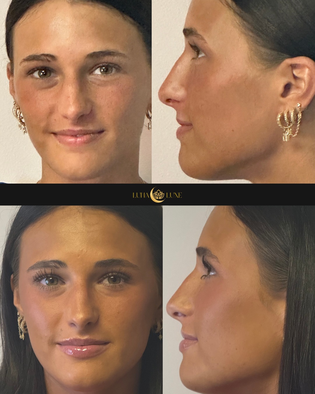 There is nothing more rewarding than watching our clients walk out feeling like the best version of themselves. ✨
Schedule your consultation today — link in bio.
#LunaLuxe #ClientResults #BeforeAndAfter #WinchesterKY #MedSpa #NaturalLook