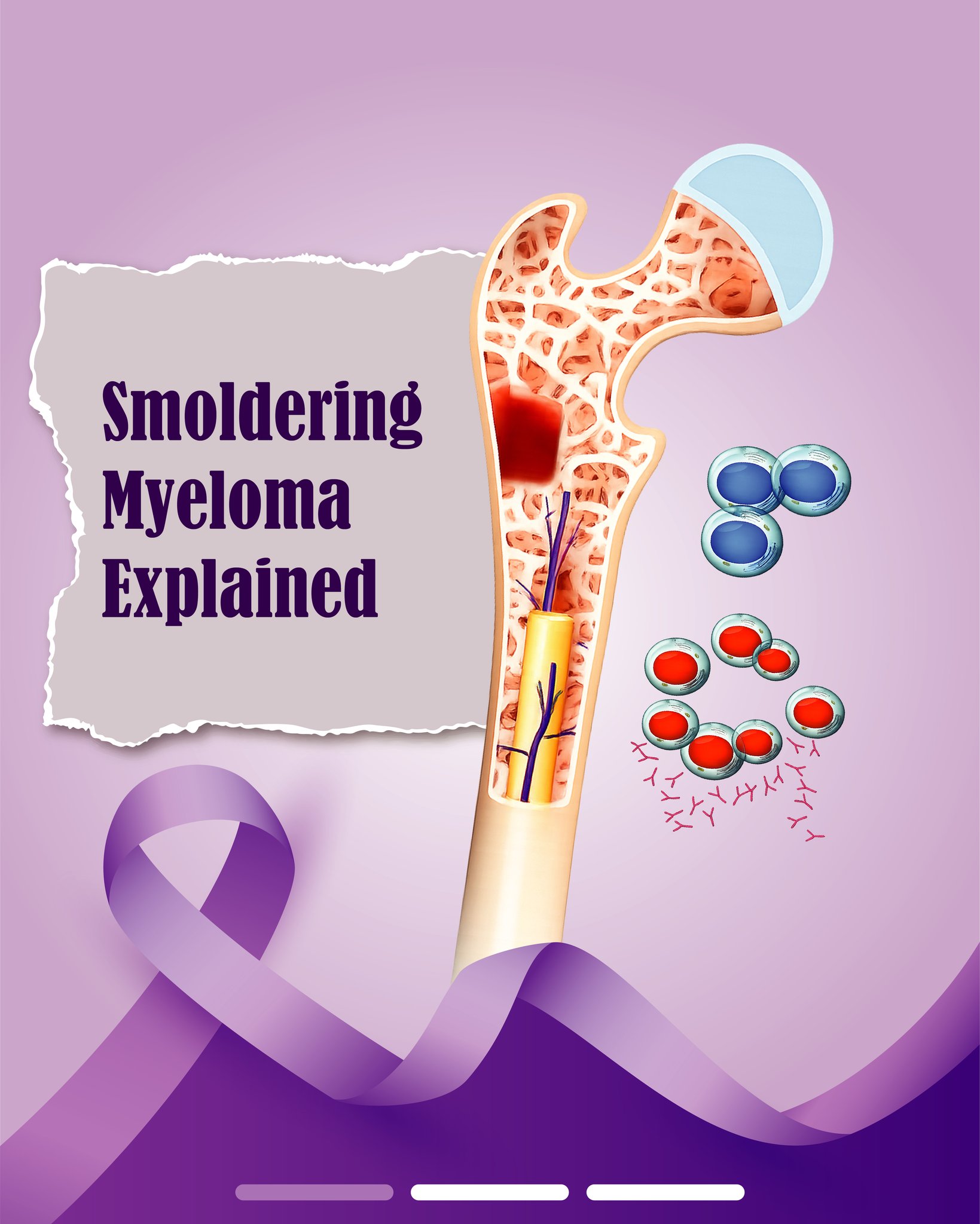 Smouldering myeloma is an intermediate stage between MGUS and active multiple myeloma—where abnormal protein levels are higher, but there are still no signs of organ damage.
While it may not require immediate treatment, it does need careful and regular monitoring to detect any progression early. Staying informed and consistent with follow-ups is key to better outcomes.
.
.
.
#smoulderingmyeloma #multiplemyeloma #blooddisorders #hematology #healthawareness #earlydetection #patientcare #preventivecare