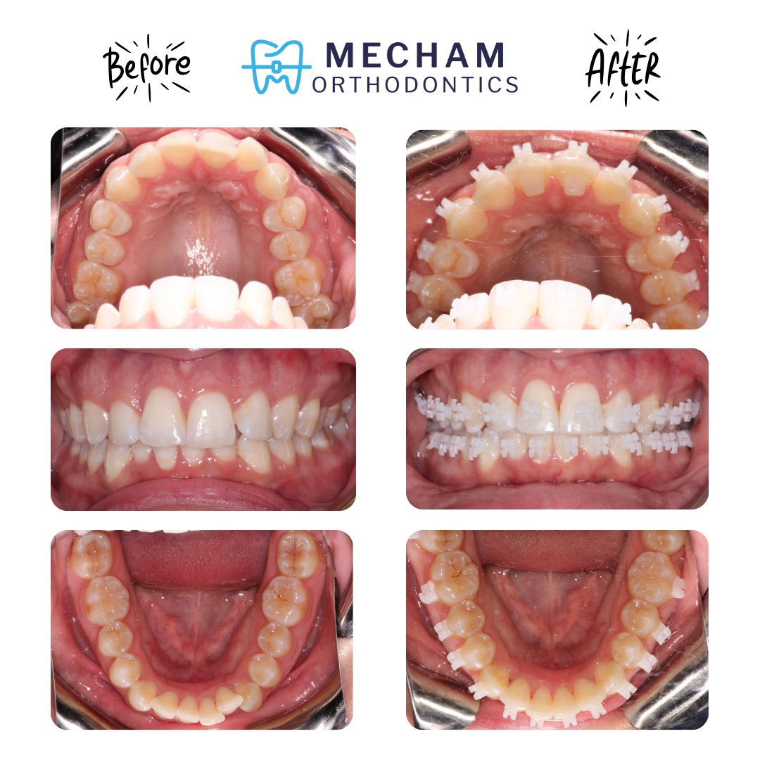 🦷 Rapid Results, Custom Precision!
Check out this incredible progress for one of our amazing patients! 🚀 In just **3.5 months**, we’ve seen some serious movement and alignment using our @wearelightforce fully custom 3D-printed clear bracket system.
Because every bracket is 3D-printed to fit the unique shape of each tooth, we can achieve more precise movements in a shorter amount of time. Clear, comfortable, and seriously fast—that’s the Mecham Ortho difference!
Are you ready to start your own transformation?
Click the link in our bio or DM us to **schedule your complimentary consultation** today!
#MechamOrtho #MechamOrthodontics #Braces #SmileTransformation #Orthodontics #SmileGoals
