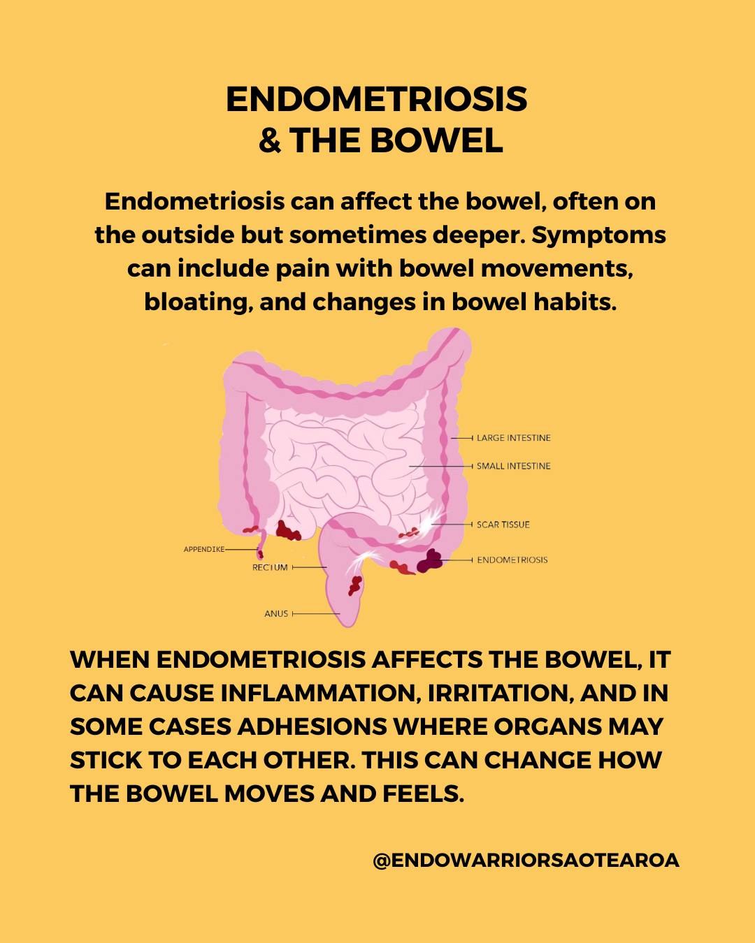 Endometriosis can affect the bowel. And it is often missed.
It is most commonly found on the outside of the bowel, but can also grow into the bowel wall. Because of this, symptoms do not always show up on standard tests.
Symptoms can include:
Pain when opening bowels, especially during a period
Bloating that does not match what you ate, Constipation, diarrhoea, or both. These symptoms are often labelled as IBS.
When endometriosis affects the bowel, it can cause inflammation, irritation, and in some cases adhesions where organs may stick to each other. This can change how the bowel moves and feels.
What you can do
Track your symptoms and when they happen
If they follow your cycle, that is important
Be clear about your bowel symptoms and how they impact your daily life
What to ask your doctor
Could this be endometriosis affecting the bowel?
Why are my symptoms happening if tests are normal?
Should I be referred to a gynaecologist or specialist?
Is specialist imaging appropriate?
A normal test does not rule this out, If something does not feel right, it is okay to ask again or seek a second opinion.
You deserve to be listened to.
You deserve proper care.
#endometriosis #endometriosisawareness #endowarriors #bowelendometriosis #invisibleillness