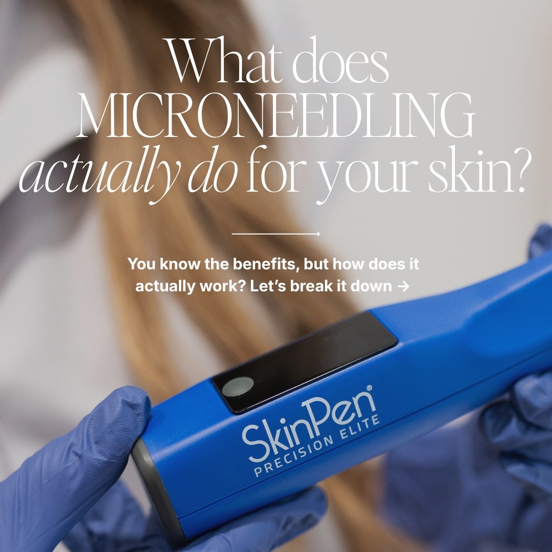 ✨ Ready to transform your skin from within? ✨
Say hello to smoother, firmer, more radiant skin with SkinPen Microneedling 💫
This collagen-boosting treatment creates tiny microchannels in the skin, triggering your body’s natural healing process—and the results are so worth it 👇
💖 Benefits of Microneedling:�• Improves fine lines & wrinkles�• Smooths acne scars + texture�• Minimizes pores�• Brightens dull skin�• Enhances product absorption�• Stimulates collagen & elastin production
Over time, your skin becomes stronger, healthier, and more youthful-looking—naturally 🙌
✨ Minimal downtime�✨ Safe for most skin types�✨ Real, long-term results
Ready to glow on a deeper level? Your future skin will thank you 🤍
Book your SkinPen Microneedling appointment today!
✨📲 Call us : 319-939-1824
📍 212 E 4th St, Waterloo, IA 50703
🔗 https://dashboard.boulevard.io/booking/businesses/e42807b0-3d4c-4aba-9313-3910c14faa57/widget#/cart/menu to schedule your appointment today
💻 rejuvenatemedspaia.org
📱RepeatMD: https://rejuvenate.repeatmd.app/signin
#medspa #waterloo #microneedling #Collagenboost #hydrafacial #rejuvenatemedspa