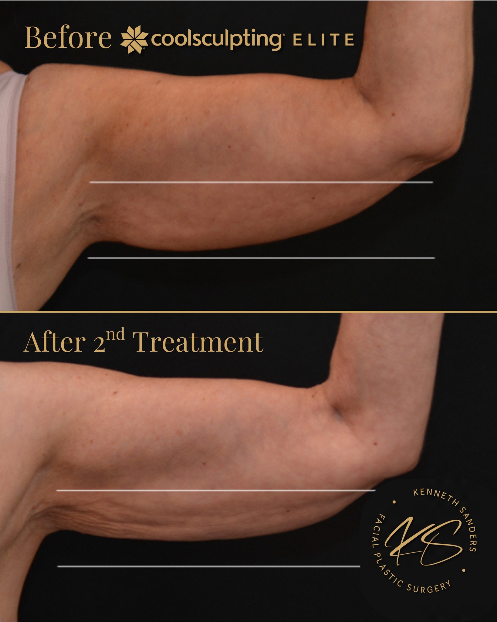 This is what happens when stubborn fat meets the right treatment. đ§
This FDA-cleared treatment uses controlled cooling to target and freeze fat cells beneath the skin without damaging surrounding tissue. Over the following weeks, your body naturally processes and eliminates those treated fat cells.
And once those fat cells are gone, theyâre gone for good.
This result is after two treatments, with continued improvement as your body keeps working behind the scenes.
No downtime. No surgery. Just gradual, natural-looking definition in an area thatâs often hard to treat.
And right now is the best time to start⌠CoolMonth is here. âď¸New patients can take $400 off treatment through Alle all April.
Call (318) 698-8711 to schedule your FREE body assessment.
#CoolSculpting #Shreveport #ArmContouring #CoolSculptingElite #DrKennethSanders