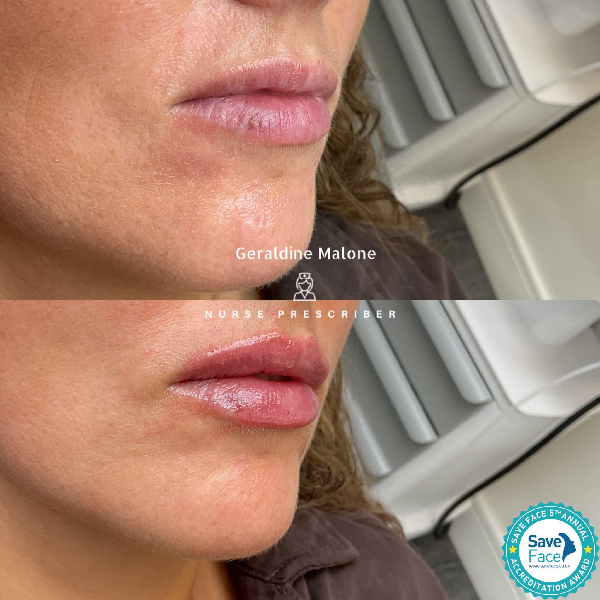 Want to enhance your lips with a subtle, natural result?
👄 0.5ml Lip Enhancement
Perfect for adding volume, hydration, and refining shape while maintaining your natural features.
- Treatment price: 0.5ml/£145, 1ml/£225
- Recovery time: 24/48hrs
- Results lasting 6-12 months
NO EDITED IMAGES
✔️ Performed by Nurse Prescriber Geraldine Malone
✔️ Save Face Registered Clinic
📅 Book now:
https://www.geraldinemalone.co.uk/book-appointment
📞 024 7792 1812
📧 geraldinemaloneaesthetics@outlook.com
