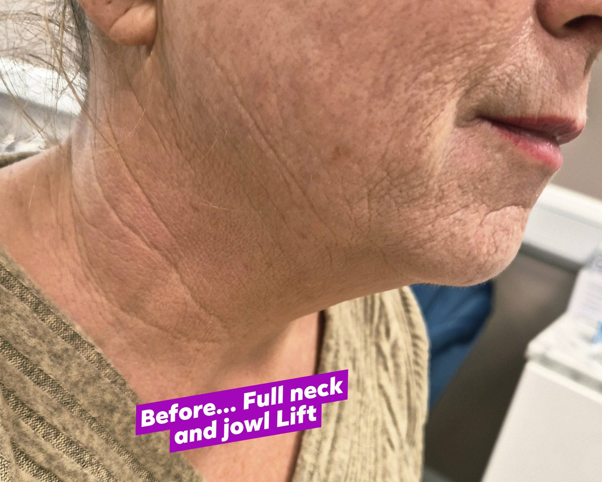 ✨ My lovely client came to me and was so unhappy with her loose skin on her neck and jawline. These photos are immediately after 10 PDO cog threads and her neck is already looking so much more sculpted, lifted, and defined with a noticeably tighter contour. And the best part? This is just the beginning — results will continue to improve as collagen builds and the skin tightens even more over the coming weeks.
A beautifully snatched jawline and elegant neck without surgery 💫
#PDOThreads #NeckLift #JowlLift #JawlineSnatched #SkinTightening #AestheticResults #NonSurgicalLift #CollagenBoost #FacialRejuvenation #BeforeAndAfter