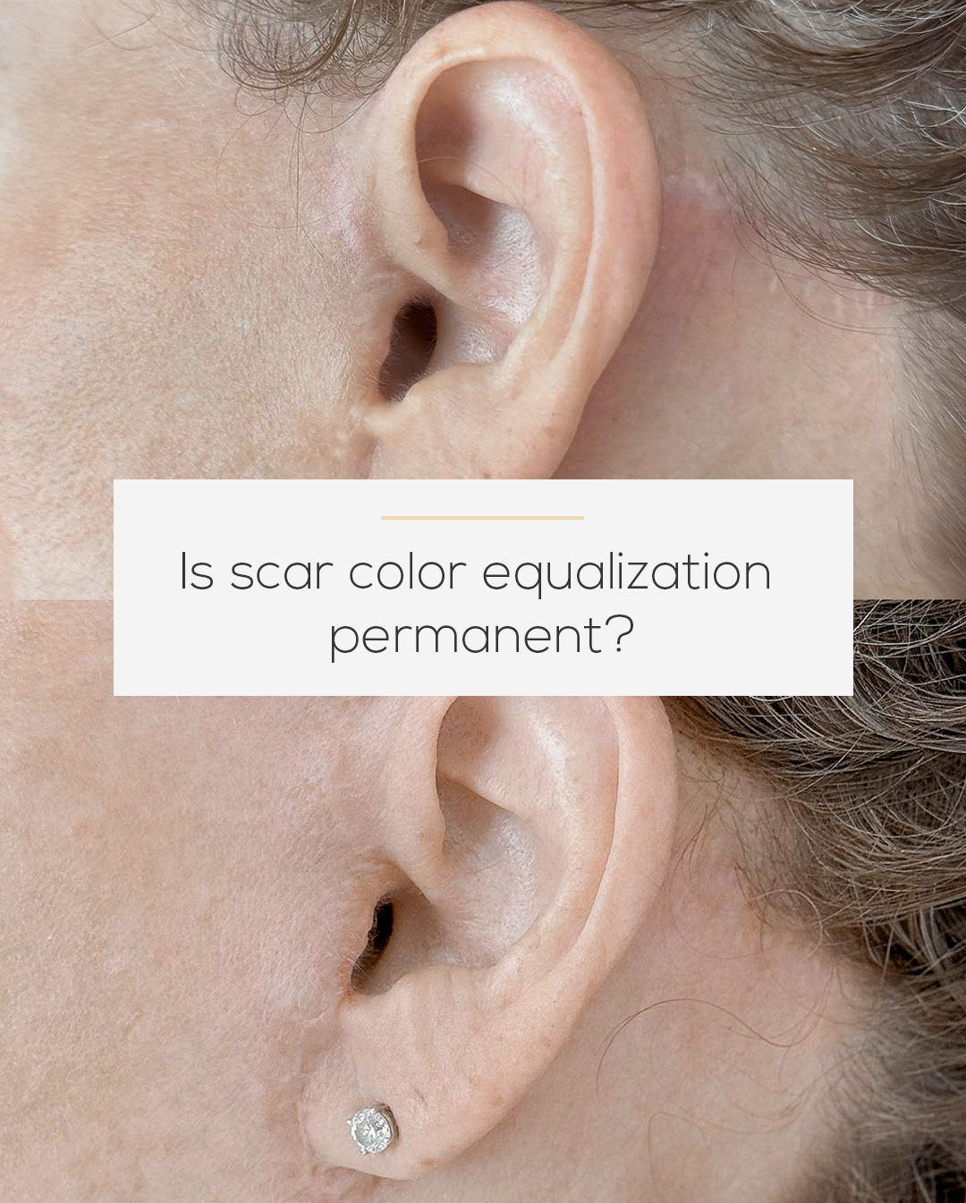 This is one of the most common questions we hear.
Many people are familiar with permanent makeup.
But our approach is different.
Instead of covering with a single tone,
we work by rebuilding color through variation.
Subtle shifts.
Different tones placed with intention.
Because your skin changes.
And a result that looks natural today should continue to make sense as time passes.
That’s why we don’t aim for permanence.
We aim for blending that stays natural
without becoming something you need to correct later.
If you’d like a clear, honest evaluation for your case,
DM SCAR and we’ll guide you with care.
📞 (754) 232-7960
🌐 priscilaiwama.com
With care,
Iwama Clinics 🤍
#scarrevision #scarremoval #medicaldermopigmentation #medicalclinica #postsurgery