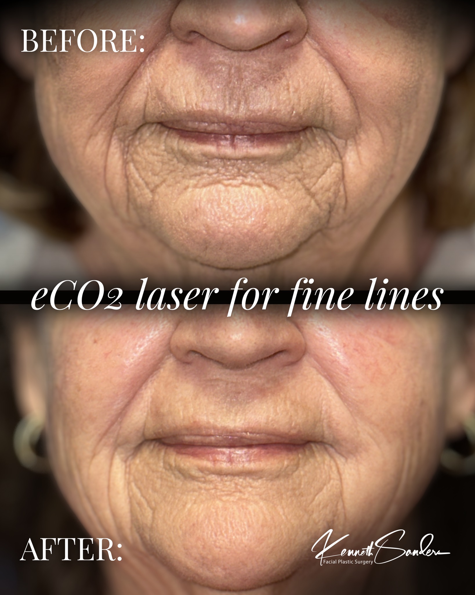 The difference targeted resurfacing can make ⚡️
The area around the mouth is one of the first places to show fine lines, texture, and deeper creasing, and one of the hardest to treat with skincare alone.
Deep eCO2 laser works by resurfacing the skin and stimulating collagen production at a deeper level, helping to soften lines, smooth texture, and improve overall skin quality.
This is where precision matters. Treating the right depth, in the right areas, makes all the difference in creating results that look natural and balanced.
Smoother skin. Softer lines. A more refreshed look without changing what makes you you.
📞 Call (318) 698-8711 to schedule your consultation
#eCO2Laser #LaserResurfacing #Shreveport #SkinRejuvenation #lasertreatment