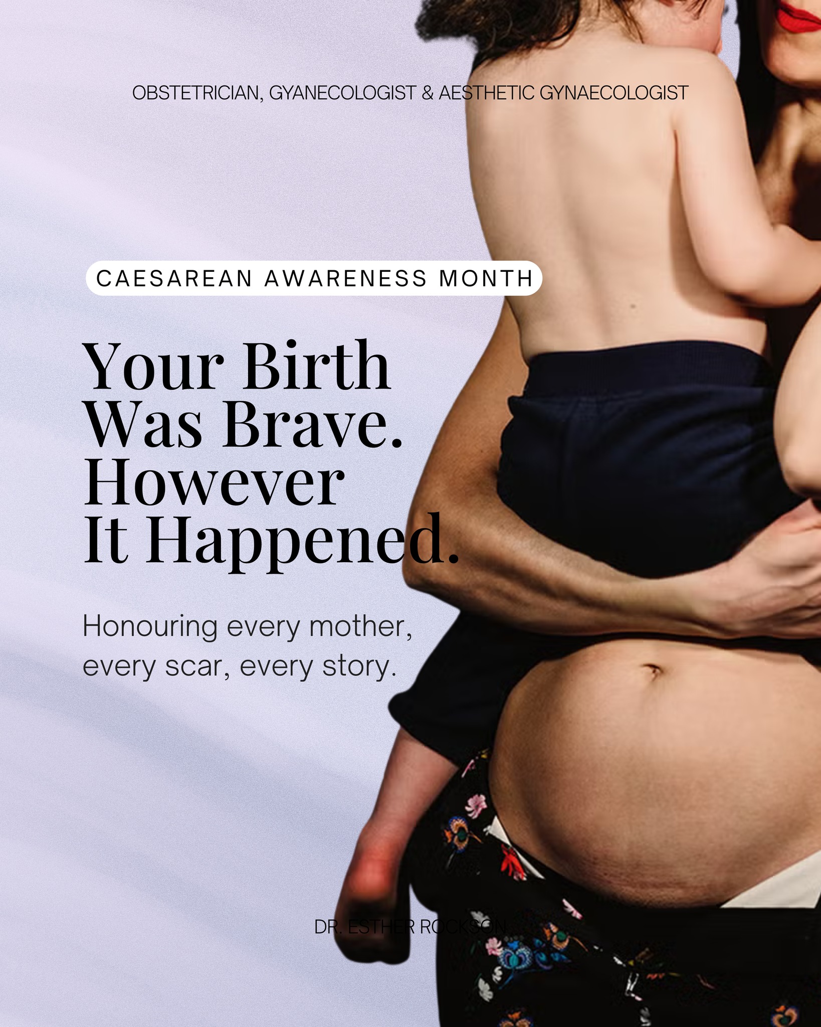💜Ladies,
A C-section is not the easy way out. It is major surgery, performed while you are awake, often under pressure, sometimes without warning; followed by the immediate, relentless demand of a newborn who does not know you are recovering.
That is not a lesser birth. That is extraordinary strength.
Caesarean Awareness Month is not just about statistics or surgical education. It is about making sure every mother who birthed this way feels seen, honoured, and completely valid in whatever she felt about the experience.
Because birth; however it unfolds, leaves a mark. Not just physical. Emotional. Psychological. Sometimes complicated, and the part we do not talk about enough is this: processing your birth experience is part of healing from it.
Whether it was everything you hoped for, nothing like you planned, or something in between; your feelings about it are real and they deserve space.
Talk to someone you trust. Write it down. Sit with it honestly, and if you are struggling to come to terms with how your birth unfolded; please reach out. To a friend, a partner, a professional, or to your nearest ob/gyn.
You are not alone in this. And there is no version of your story that is not worth honouring💜
— Dr. Esther Rockson
Obstetrician · Gynaecologist · Aesthetic Gynaecologist
Busamed Hospital, Modderfontein | Linbro Park
📞 011 458 2369 | 011 458 2118
📧 busamed@docroc.co.za
📍 4 Cransley Crescent, Midrand
#drestherrockson #obstetrician #pregnancyawareness