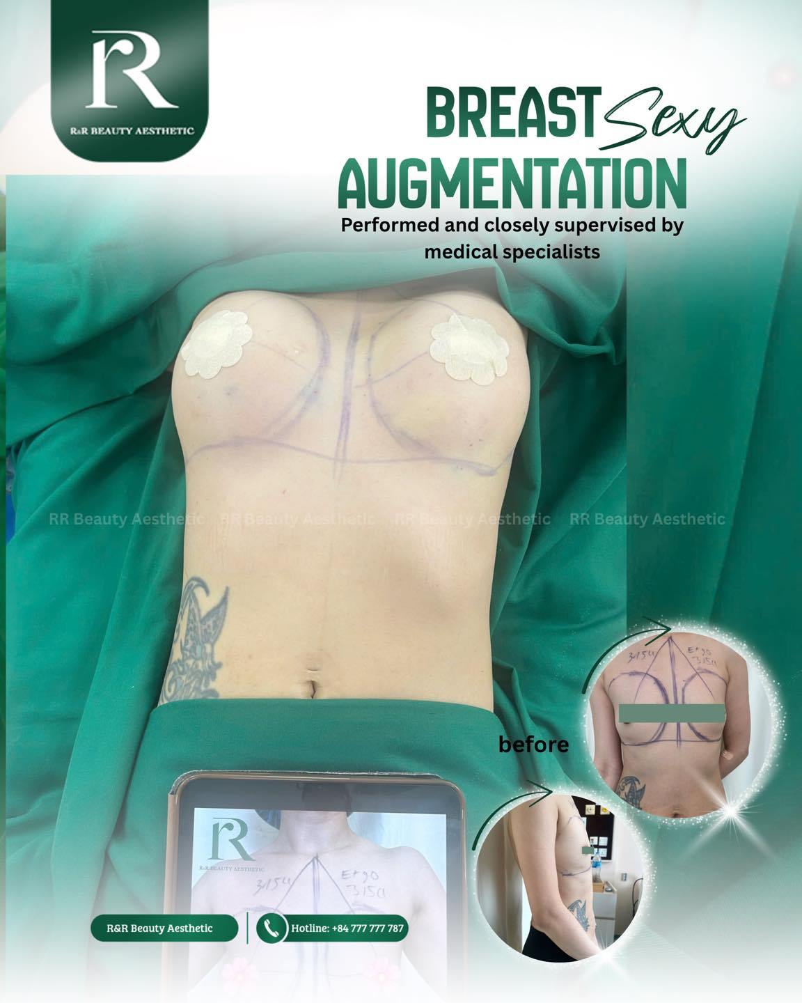 Breast augmentation:
✨ Fuller, more lifted breasts with natural projection
✨ Improved symmetry and balanced proportions
✨ A rounder, softer, more feminine contour
✨ Better fit in clothing
✨ A boost in confidence from a more defined silhouette
DM “BREAST” to get your personalized consultation today 💬
.
.
.
#breastaugmentation #naturalresults #bodycontouring #aestheticclinic #confidenceboost
breast augmentation results natural breast shape implant surgery before after fuller breasts symmetry breast contour aesthetic clinic natural look body transformation confidence feminine silhouette