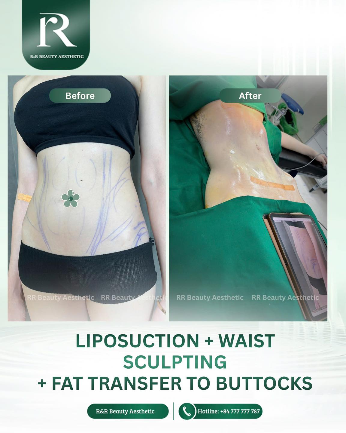 Liposuction + Waist Sculpting + Fat Transfer to Buttocks — sculpted exactly where it matters 🔥
🔥 A flatter, tighter abdomen
🔥 A smaller, more defined waistline
🔥 Fuller, rounder buttocks using your own fat
🔥 A smoother, more balanced body contour
🔥 A more feminine, hourglass silhouette
DM for your personalized consultation today 💬
.
.
.
#liposuction #waistsculpting #fattransfer #bodycontouring #hourglassfigure
liposuction results waist sculpting fat transfer buttocks body contouring hourglass body slim waist curvy shape before after transformation body shaping aesthetic clinic natural curves body confidence makeover