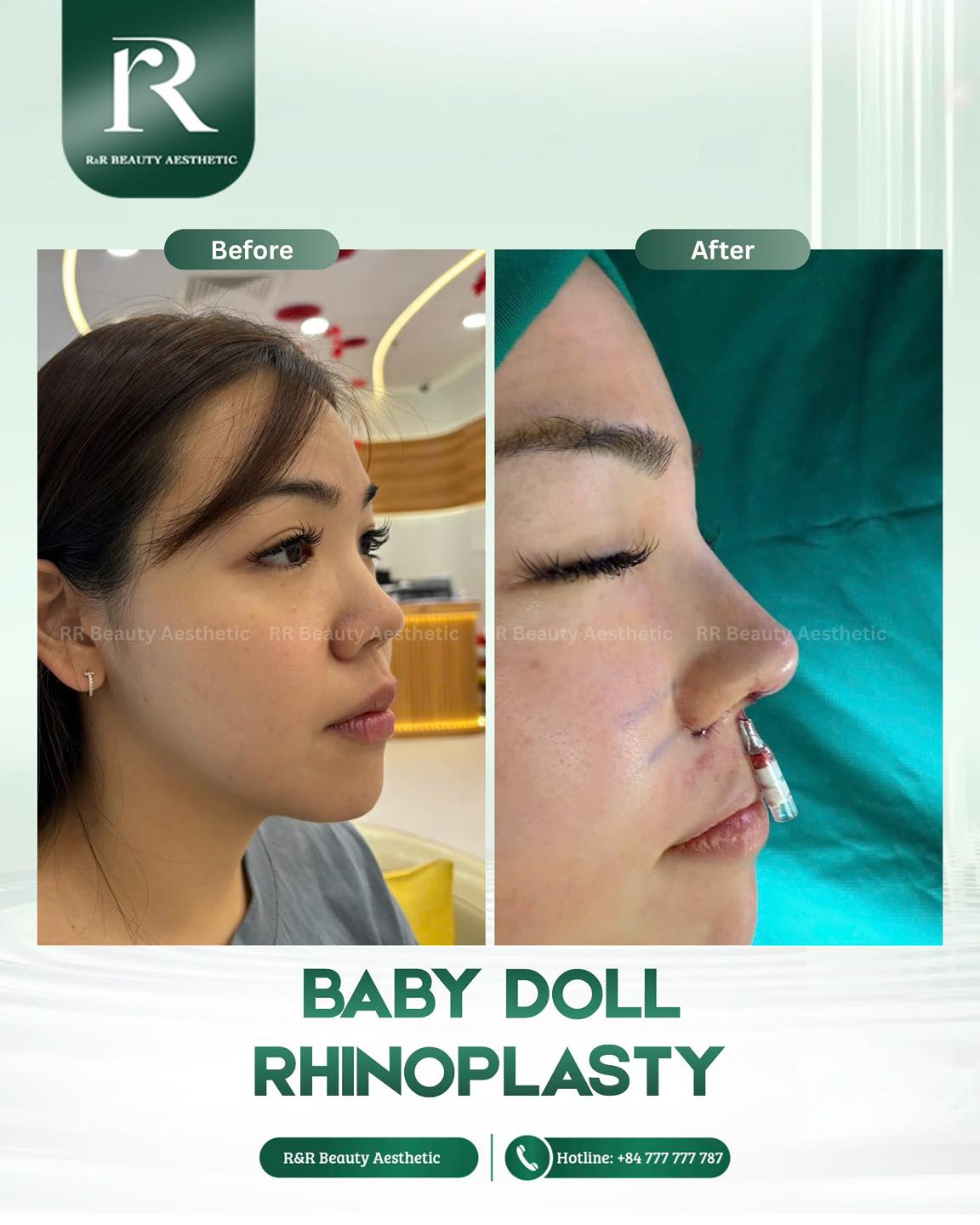 BABY DOLL RHINOPLASTY
Soft, sweet… and naturally beautiful — the Baby Doll nose everyone’s loving 💗
✨ A softly lifted, naturally curved nose bridge
✨ A delicate, slightly upturned tip for a youthful look
✨ More balanced and harmonious facial proportions
✨ A gentler, more feminine overall profile
DM to get your personalized consultation today 💬
.
.
.
#babydollnose #rhinoplasty #nosesurgery #facialharmony #naturalbeauty
baby doll rhinoplasty natural nose job soft nose shape nose tip lift facial harmony aesthetic clinic nose contouring before after natural results feminine look nose shaping beauty transformation