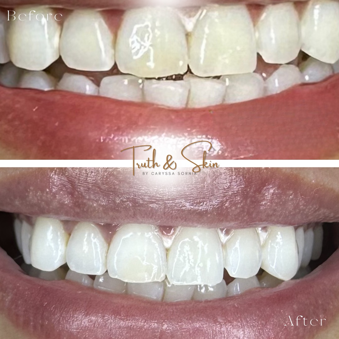Nothing beats seeing confidence shine through a smile 🤍
The first grid shows the difference between two treatments completed 6 months apart leading up to her wedding day.
The second grid shows her original starting shade and the brighter results we achieved after just one Signature Teeth Whitening session ✨
And no, there’s no filter on these photos. Just real results.
Results are unique to each individual and may vary depending on natural tooth shade, enamel condition, and daily habits.
🤍 Promotional Days
🦷 Teeth Whitening Tuesday - 10% off all teeth whitening treatments booked on Tuesdays.
✨ Signature Service Saturday - $10 off all Signature Services booked on Saturdays.
Includes:
✨ Radiance Facial
✨ Timeless Facial
✨ Pore-Purification Facial
✨ Signature Back & Neck Treatments
✨ Signature Teeth Whitening
Ready for a brighter smile?
👉 Reserve your appointment through the link in bio or visit TruthAndSkin.com
📍 1449 W 9 Mile Rd. Ste 1
Pensacola, FL 32534
Cannot be combined with other promotions or discounts.