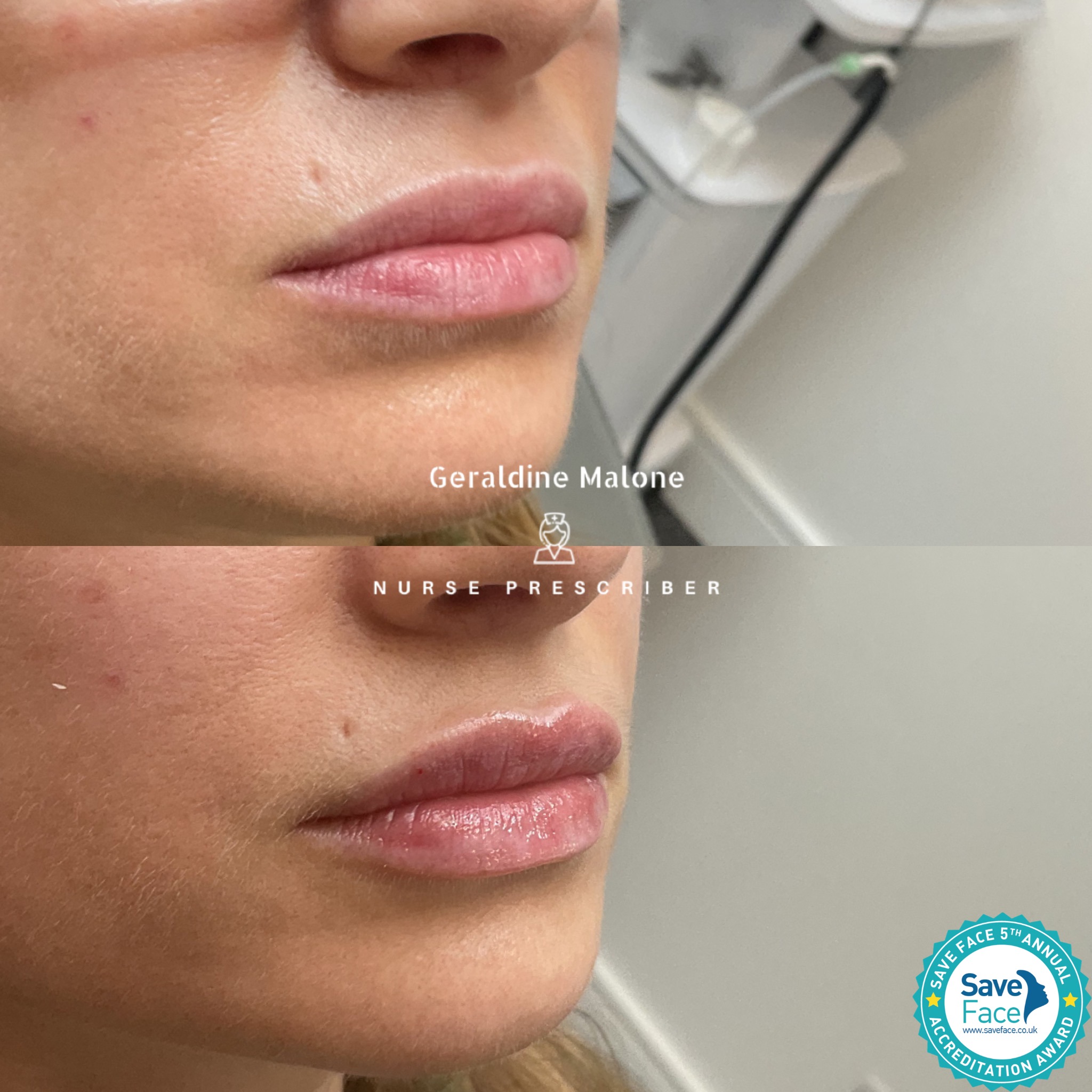 Ideal for those wanting a subtle enhancement, added volume, hydration, and gentle definition, while keeping results natural.
💉0.5ml Lip Enhancement Treatment
- NO edited images
- Treatment price: 0.5ml/£145, 1ml/£225
- Recovery time: 24/48hrs
- Results lasting 6-12 months
All treatments carried out by Nurse Prescriber Geraldine Malone in a Save Face Registered Clinic.
Book Now via the link below:
https://www.geraldinemalone.co.uk/book-appointment
Contact Us:
☎️ 024 7792 1812
📧 geraldinemaloneaesthetics@outlook.com