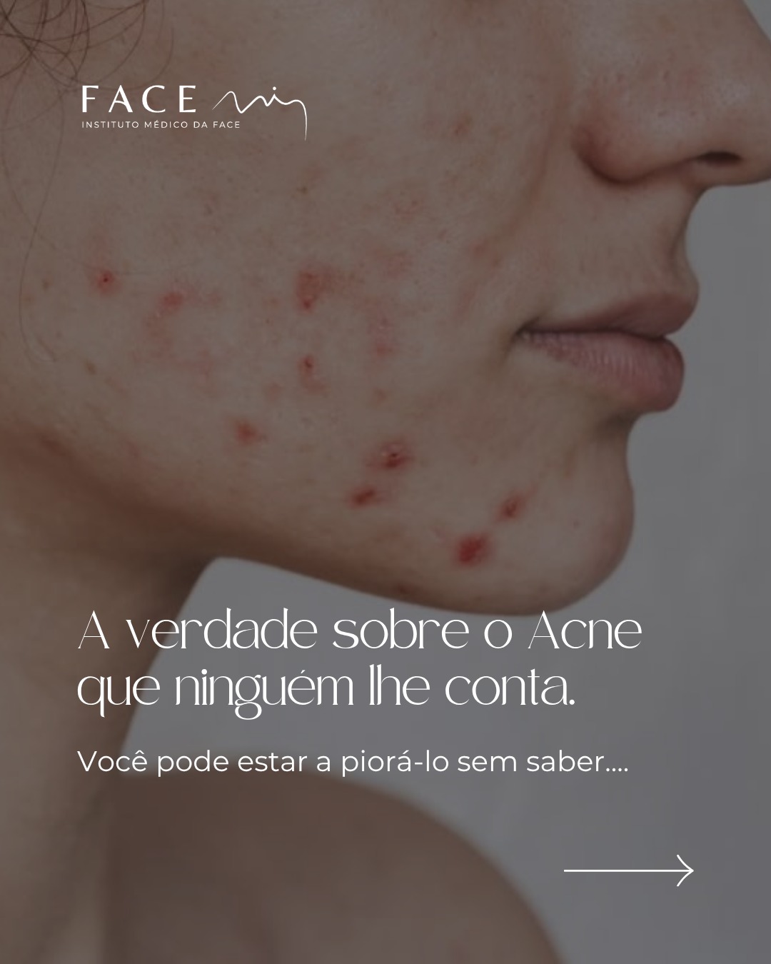 Quando se trata de acne muitas vezes podemos estar a ser demasiado agressivos com a nossa pele.
Se a inflamação e a sensibilidade não são tratadas, o acne continua.
Uma consulta médica é o primeiro passo para travar o ciclo, medicação prescrita, dermocosmética ajustada, parar o ciclo de inflamação e deixar respirar o poro com Hydrafacial assim como tratar a inflamação com BBL são dos melhores tratamentos para a pele com acne.
Se se revê nisto, está na altura de fazer diferente.
Agende a sua consulta médica no Instituto Face Mi.
#bbl #laseracne #facemi #bblacne
Todos os pacientes, antes de cada procedimento, passam por um processo de consulta médica de diagnóstico onde são avaliadas indicações, expectativas e motivações.
Registo ERS: 21236
Registo estabelecimento: E159774
Licença funcionamento: 21236/2022