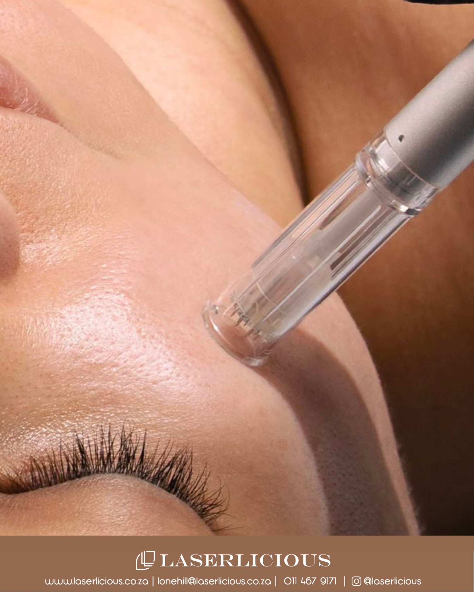 Microneedling works with your skin - not against it.
Tiny microchannels are created in the skin to trigger natural healing and collagen renewal. This helps improve texture, reduce scarring and restore a more even, radiant complexion.
Faster and more precise than traditional rollers, the treatment is customised to suit your skin’s needs for safe, effective results.
Book your microneedling consultation today. Call Laserlicious on 011 467 9171 / lonehill@laserlicious.co.za 📞