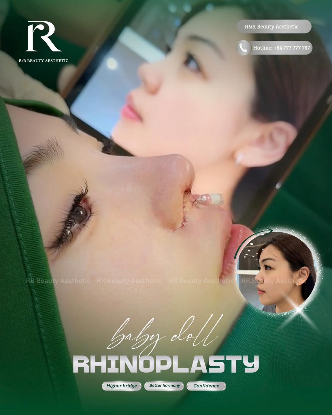 Soft profile. Better harmony. More confidence ✨
Baby Doll Rhinoplasty:
✨ Higher bridge
✨ Better harmony
✨ More confidence
Combined with post-rhinoplasty Dermalux light therapy, the recovery process becomes more comfortable while supporting faster healing and better-looking results.
DM for your personalized consultation today 💬
Contact Information:
Vietnam Clinic
R&R Beauty Aesthetic / R&R Beauty Clinic
📍 10A Truc Duong, An Khanh Ward, Ho Chi Minh City, Vietnam
Singapore Studio
R&R Beauty Studio
📍 416 Ang Mo Kio Ave 10, #01-985, Singapore 560416
.
.
.
#babydollrhinoplasty #rhinoplasty #naturalresults #facialharmony #dermalux
baby doll rhinoplasty natural nose job higher bridge facial harmony confidence glow up dermalux recovery light therapy post rhinoplasty care aesthetic clinic nose contouring before after feminine profile natural beauty soft nose shape
