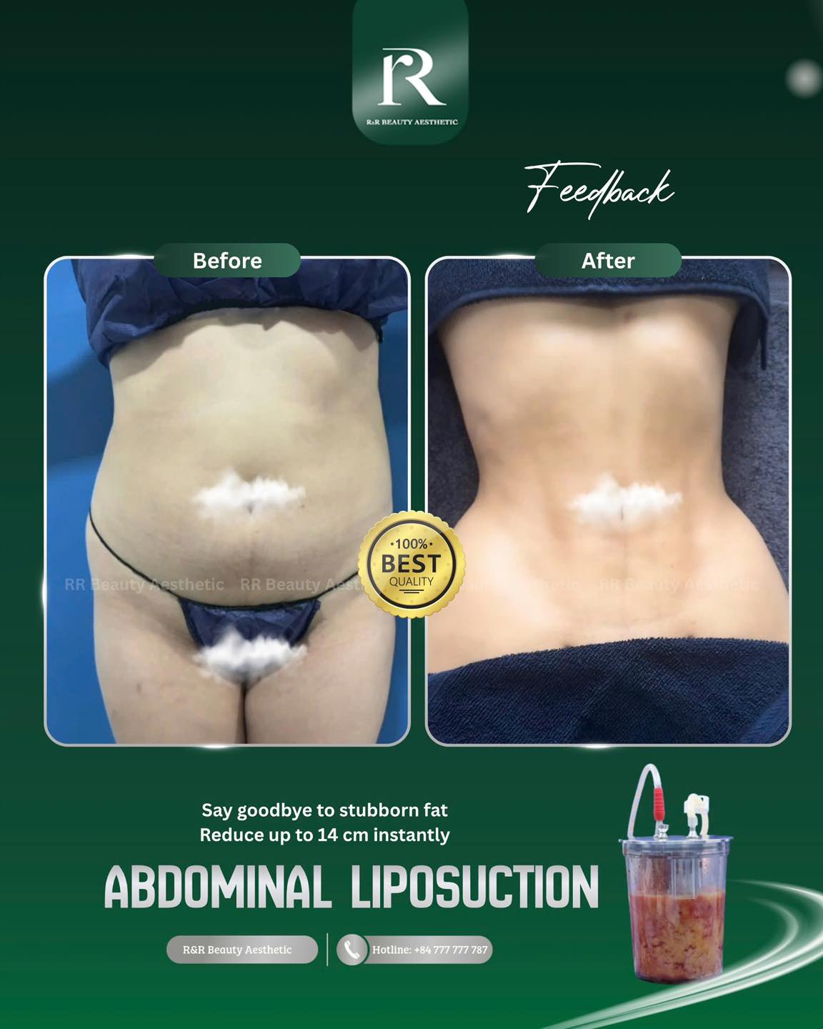 ✨ Abdominal Liposuction:
✔ Helps reduce stubborn abdominal fat
✔ Supports a slimmer and more defined waistline
✔ Personalized body contouring approach
✔ Natural-looking and balanced results
✔ Premium aftercare with 1:1 support throughout recovery
.
Contact Information:
Vietnam Clinic
R&R Beauty Aesthetic / R&R Beauty Clinic
📍 10A Truc Duong, An Khanh Ward, Ho Chi Minh City, Vietnam
Singapore Studio
R&R Beauty Studio
📍 416 Ang Mo Kio Ave 10, #01-985, Singapore 560416
.
.
.
#abdominalliposuction #bodycontouring #liposuction #medicalaesthetics #rrbeautyaesthetic
abdominal liposuction, waist contouring, body sculpting treatment, stubborn fat reduction, slimmer waistline, luxury aesthetic clinic, premium beauty clinic, body reshaping treatment, cosmetic body contouring, feminine body silhouette, medical aesthetics, abdominal fat removal