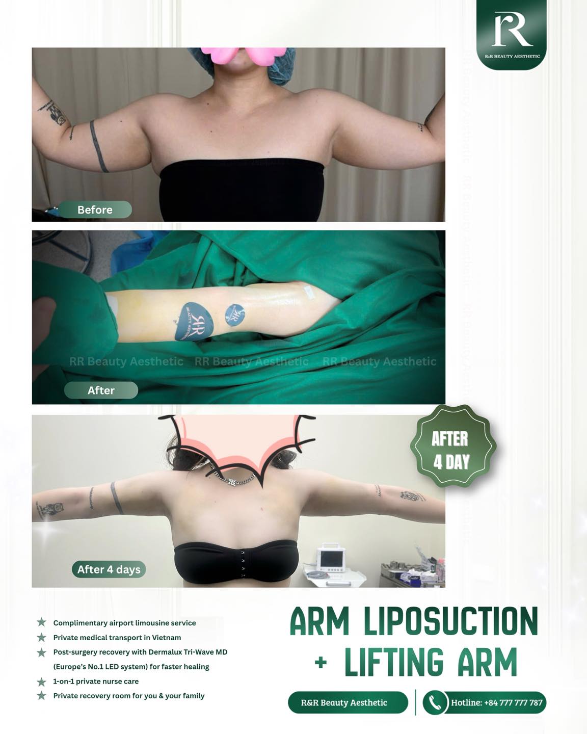 ✨ Slimmer arms are not just about fat reduction.
Arm Liposuction + Arm Lifting:
✔ Helps reduce stubborn arm fat
✔ Combined lifting technique to support firmer-looking skin
✔ More defined and balanced arm shape
✔ Struggling with arm fat resistant to workouts and dieting
✨ Premium post-procedure care
✨ Private recovery experience
✨ 1:1 support throughout your journey
DM for your personalized consultation today 💬
Contact Information:
Vietnam Clinic
R&R Beauty Aesthetic / R&R Beauty Clinic
📍 10A Truc Duong, An Khanh Ward, Ho Chi Minh City, Vietnam
Singapore Studio
R&R Beauty Studio
📍 416 Ang Mo Kio Ave 10, #01-985, Singapore 560416
.
.
.
#armliposuction #armlift #bodycontouring #luxuryaestheticclinic #rrbeautyaesthetic
arm liposuction, lifting arm, slimmer arms treatment, body contouring clinic, premium aesthetic clinic, arm fat reduction, skin tightening treatment, luxury beauty clinic, cosmetic surgery korea style, upper arm contouring, aesthetic transformation, feminine arm shape, medical aesthetics, arm sculpting, confidence makeover