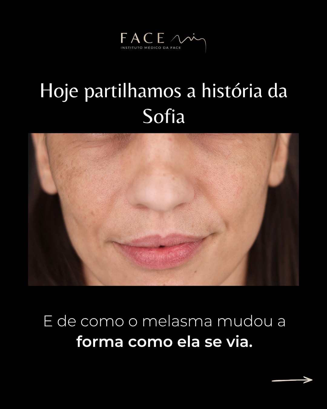 A Sofia começou a olhar-se ao espelho e
a ver primeiro as manchas.
E, aos poucos, começou a sentir que precisava de maquilhagem todos os dias.
O melasma estava a afetar mais do que a pele: estava a afetar a forma como a Sofia se via. Foi então que percebeu que precisava de ajuda e marcou uma consulta na Face Mi.
O plano foi simples:
cuidar, controlar as manchas
e devolver luminosidade à pele.
Hoje, a Sofia voltou a sair de casa com mais leveza e confiança. Porque a maquilhagem deve ser uma escolha. Nunca uma obrigação.
Faça como a Sofia:
marque uma consulta na Face Mi
e faça as pazes com o espelho
Todos os pacientes, antes de cada procedimento, passam por um processo de consulta médica de diagnóstico onde são avaliadas indicações, expectativas e motivações.
Instituto Médico da Face - Face Mi
Porto e Braga
Telef: 913553361
Registo ERS: 21236
Registo estabelecimento: E159774
Licença funcionamento: 21236/2022