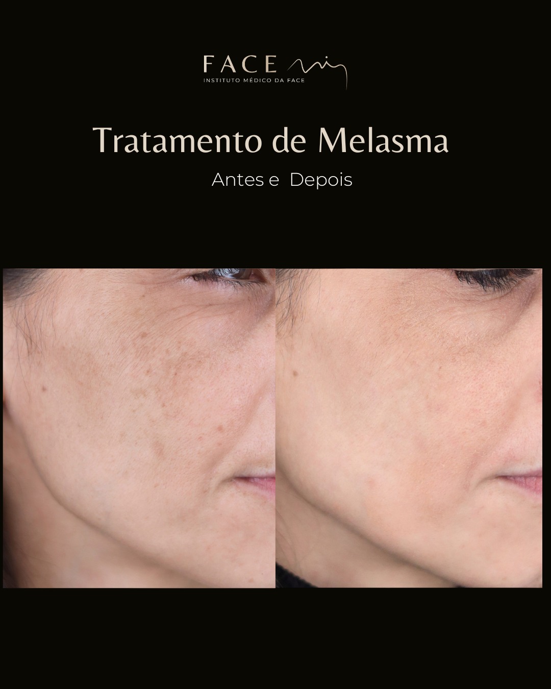 Melasma não é “só uma mancha”.
É uma condição crónica, complexa e profundamente impactante na autoestima de muitas mulheres.
E não, tratar melasma não é apenas “fazer laser”. É preciso perceber a causa, o tipo de pigmento, a inflamação da pele e criar um plano personalizado e consistente.
Neste antes e depois, o objetivo não foi “apagar” a pele natural da paciente.
Foi devolver uniformidade, luminosidade e confiança — respeitando a saúde da pele em cada etapa.
Resultados reais exigem:
• diagnóstico médico
• combinação de tratamentos
• skincare adequado
• proteção solar rigorosa
• manutenção
Porque no melasma, tratar sem estratégia é muitas vezes piorar.
Se sente que já tentou “de tudo” sem resultados duradouros, talvez o problema nunca tenha sido a sua pele — mas sim a abordagem.
O caso clínico apresentado reflete o antes e depois de um paciente específico que deu o seu consentimento para ser apresentado nos canais e redes sociais do Instituto Face Mi. Cada pessoa é única e o resultado pode variar de paciente para paciente.
Instituto Médico da Face - Face Mi
Porto e Braga
Telef: 913553361
Registo ERS: 21236
Registo estabelecimento: E159774
Licença funcionamento: 21236/2022