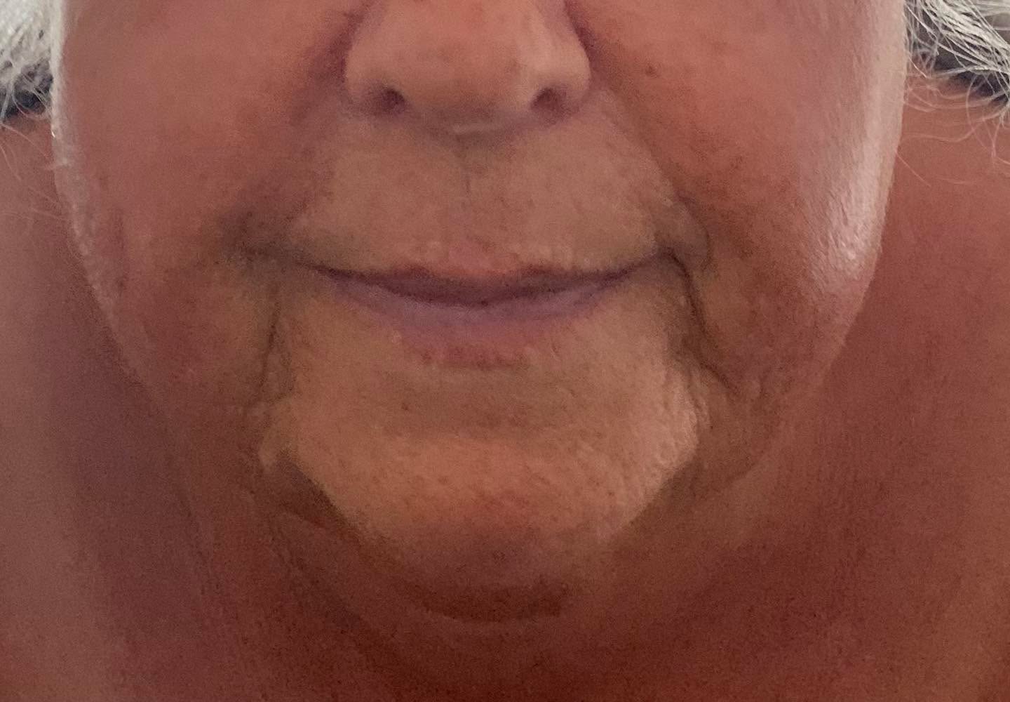 I am thrilled to share these spectacular results from a recent client’s first Zone Face Lift treatment.
Zone Face Lift offers a natural, non-invasive alternative to modern aesthetics. By combining facial reflexology, traditional Japanese massage, and advanced lifting techniques, this holistic therapy rejuvenates the face while balancing the body's systems.
Every bespoke session incorporates:
* Facial Reflexology: Stimulates targeted pressure points for overall well-being.
* Japanese Massage: Enhances circulation and relieves facial muscle fatigue.
* Gua Sha: Promotes lymphatic drainage to visibly smooth fine lines.
* Acupressure Rollers: Radiates the complexion and encourages deep relaxation.
(Client gave me permission to use the photos)
#zonefacelift#natural#facelift#facialreflexology#japanesemassage#guasha#acupressurerollers#purealton#altonhampshire