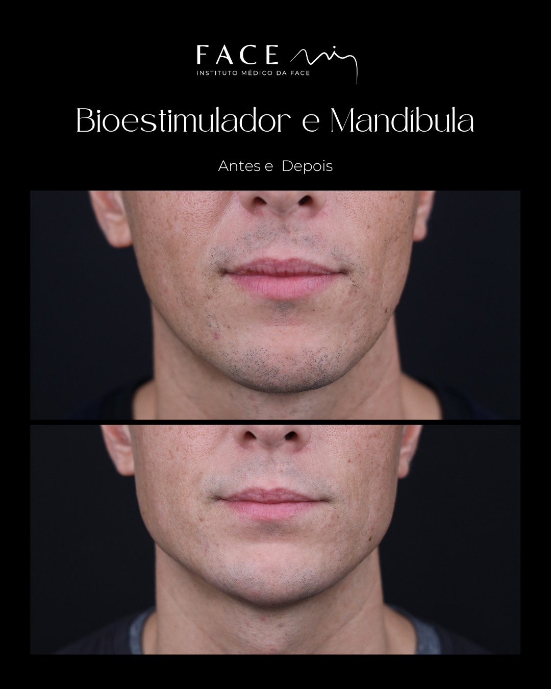 A mandíbula define a presença. Quando a linha da mandíbula ganha força e definição, o rosto inteiro transforma-se.
O perfil fica mais vincado, o contorno mais impactante, a presença mais autêntica.
O Preenchimento de Mandíbula é rápido, seguro e com resultados imediatos.
Realçamos a anatomia masculina, melhoramos o contorno e estruturamos o ângulo que marca o rosto - sem exageros, apenas definição onde faz falta.
Se sente que o seu rosto perdeu estrutura ou que nunca teve a mandíbula que gostaria: não está sozinho.
Uma consulta médica personalizada é o primeiro passo para encontrar a sua versão mais autêntica e impactante.
O caso clínico apresentado reflete o antes e depois de um paciente específico que deu o seu consentimento para ser apresentado nos canais e redes sociais do Instituto Face Mi. Cada pessoa é única e o resultado pode variar de paciente para paciente.
Instituto Médico da Face - Face Mi
Porto e Braga
Telef: 913553361
Registo ERS: 21236
Registo estabelecimento: E159774
Licença funcionamento: 21236/2022
