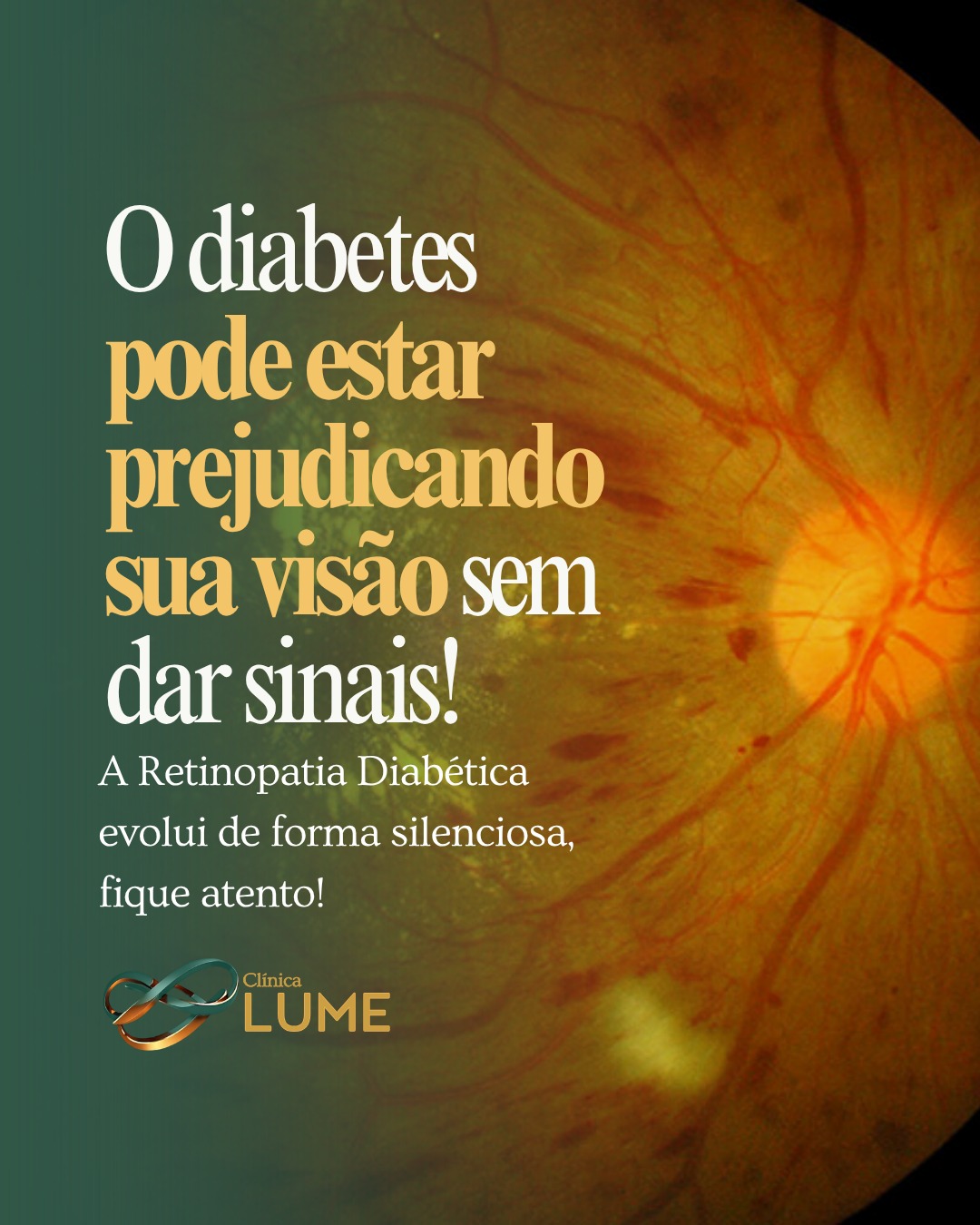 O diabetes pode estar prejudicando sua visão sem dar sinais!
A Retinopatia Diabética evolui de forma silenciosa e pode comprometer a retina antes mesmo dos primeiros sintomas aparecerem.
✔️ Controle do diabetes
✔️ Exames oftalmológicos regulares
✔️ Diagnóstico precoce
Tudo isso pode fazer diferença na preservação da sua visão.
Na Lume Oftalmologia e Cirurgia, sua retina é acompanhada com tecnologia, precisão e cuidado especializado.