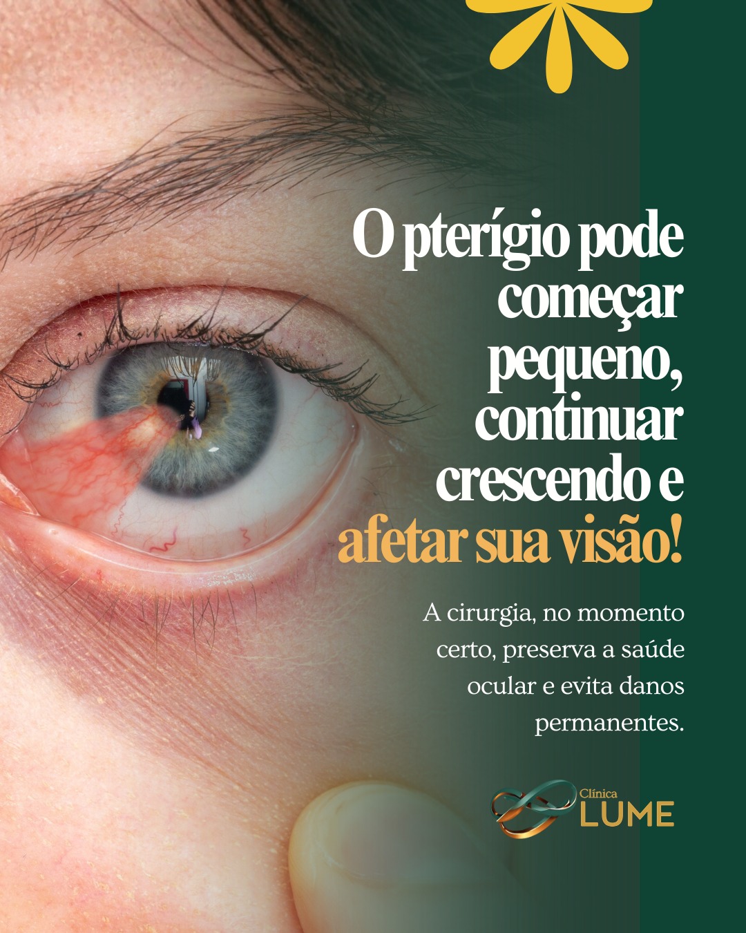 Além da estética, ele pode causar inflamações, astigmatismo e alterações na córnea.
A cirurgia, no momento certo, preserva a saúde ocular e evita danos permanentes.
Na Lume Oftalmologia e Cirurgia, cada caso é avaliado de forma individualizada, com precisão e acompanhamento especializado.