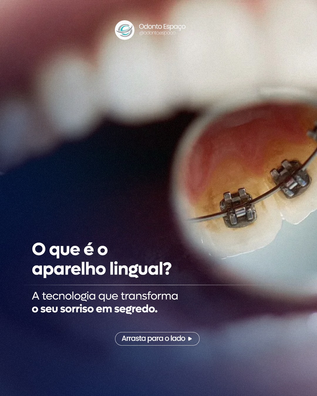 E se você pudesse conquistar o alinhamento perfeito sem que ninguém percebesse que você está em tratamento? 🤫🦷
O aparelho lingual é uma verdadeira engenharia oculta na odontologia. Através de braquetes de perfil reduzido, colados estritamente por trás dos dentes, conseguimos movimentar as raízes com precisão milimétrica, tratando desde pequenos apinhamentos até disfunções de mordida complexas. 🔬📐
O metal nunca toca os seus lábios, mantendo a sua estética intacta e permitindo que você veja a evolução do seu sorriso em tempo real, sem nenhuma interferência na sua rotina social ou profissional. 💎✨
Tecnologia, discrição e alta performance biológica.
👉 Para conhecer os detalhes dessa tecnologia, clique no link da bio e agende sua consulta. 📩
#AparelhoLingual #OrtodontiaInvisivel #OdontoEspaco #EngenhariaOculta #EsteticaDental #AltaPerformance #VilaMariana #OrtodontiaEstetica #odontoespaço #dentistavilamariana #vilamarianasp #VilaMariana #ortodontia #ortodentista #dentistasp