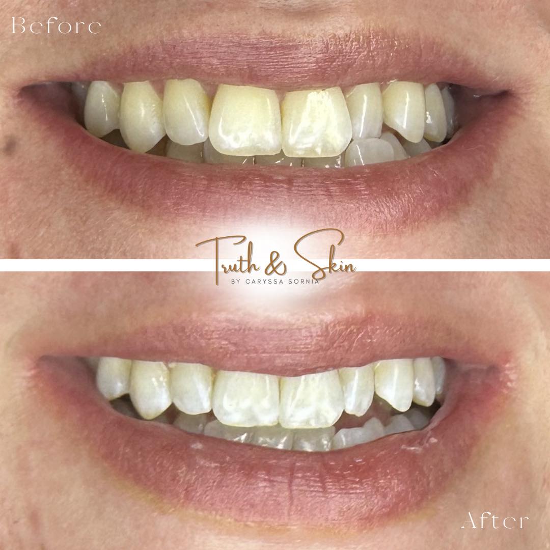 Truth & Skin’s Signature Teeth Whitening
Results are unique to each individual and may vary depending on natural tooth shade, enamel condition, and daily habits.
🤍 Promotional Days
🦷 Teeth Whitening Tuesday - 10% off all teeth whitening treatments booked on Tuesdays.
✨ Signature Service Saturday - $10 off all Signature Services booked on Saturdays.
📍1449 W Nine Mile Rd.
Ste 1 Pensacola, FL 32534
#teethwhitening #teethwhiteningpensacola #beforeafter