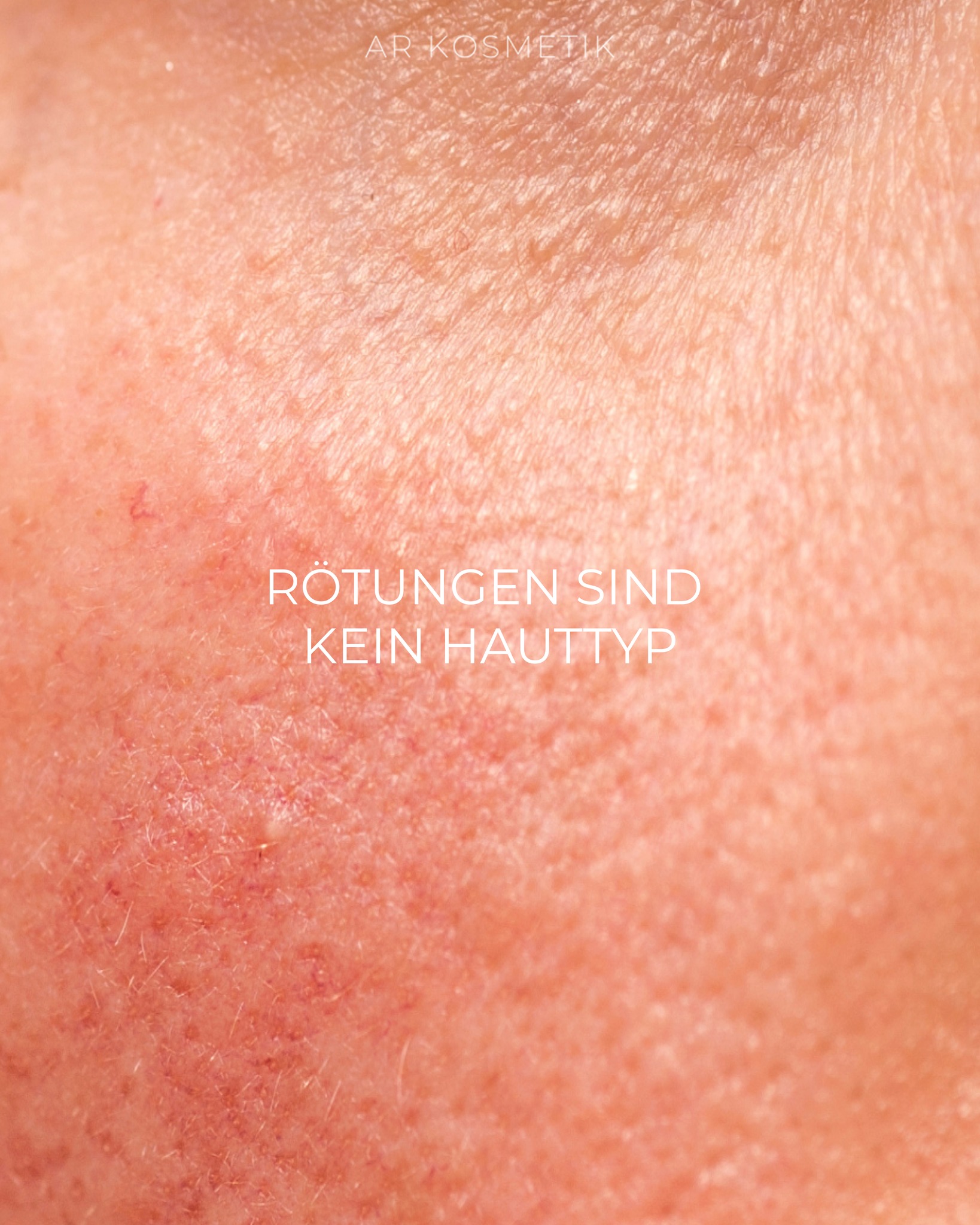 Wenn die Haut empfindlich reagiert, lohnt sich ein zweiter Blick.
Rötungen, sichtbare Äderchen, ein Gefühl von Hitze oder Brennen: Rosazea zeigt sich auf vielfältige Weise und betrifft vor allem die Mitte des Gesichts: Wangen, Nase, Stirn und Kinn. Die Ursache liegt tiefer als die Haut. Rosazea ist mit einer gestörten Gefäßregulation, einer veränderten Hautbarriere und entzündlichen Prozessen verbunden. Sie lässt sich nicht „wegcremen“ aber gezielt beruhigen.
Bei AR Kosmetik arbeiten wir mit beruhigenden Wirkstoffen, barrierestärkenden Behandlungen und einem klaren Pflegekonzept. Immer abgestimmt auf deinen Hautzustand.
Wenn du das Gefühl hast, deine Haut nicht mehr zu verstehen:
Lass uns gemeinsam hinschauen.
#rosazea #arkosmetikmünchen #kosmetikstudiomünchen #hautanalyse #altstadtmünchen