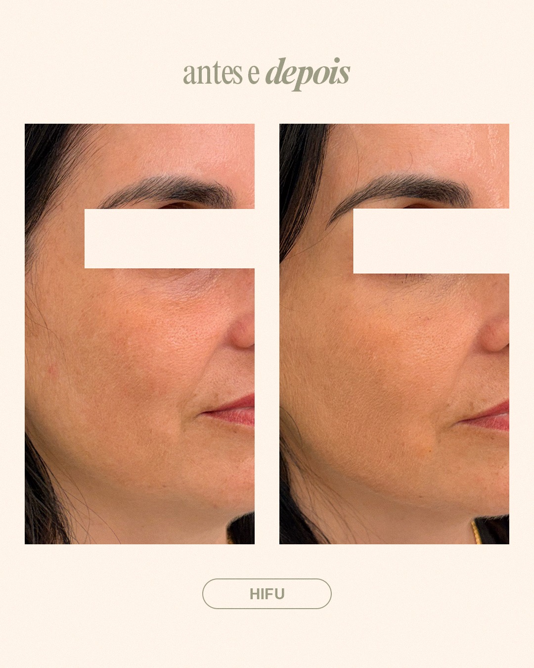 Nem todos os resultados são imediatos. Alguns constroem-se com o tempo. 💛
Neste caso, o HIFU foi utilizado para estimular a produção natural de colagénio, promovendo uma melhoria progressiva da firmeza e da qualidade da pele.
Se tiver dúvidas ou quiser mais informações, envie-nos uma mensagem privada.
*Conteúdo informativo, em respeito pelas normas éticas e deontológicas. Os resultados variam de pessoa para pessoa. Não dispensa a consulta médica para uma análise personalizada.
#clinicametamorfose #drabeatrizflores #medicinaestetica #dermatologia