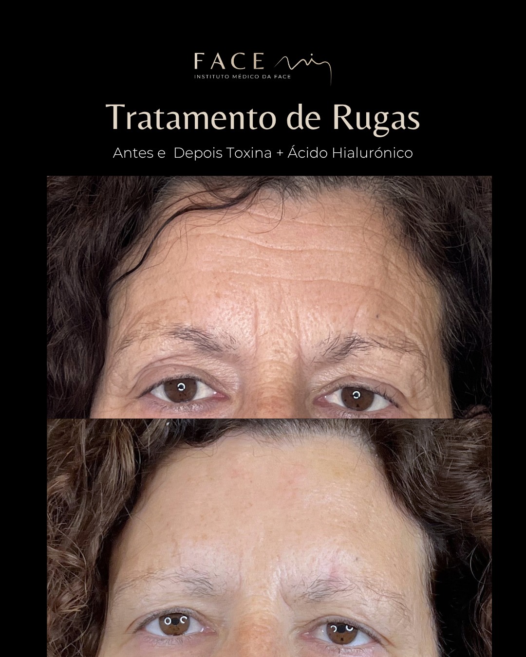 A diferença está nos detalhes e na forma como o rosto os expressa.
Neste caso, a combinação de toxina botulínica e ácido hialurónico permitiu suavizar marcas, restaurar equilíbrio e realçar a beleza natural da paciente.
Agende a sua consulta médica e descubra o plano mais indicado para si.
#rugastesta #preenchimentofacial #toxinabotulinica #facemi
Os casos clínicos apresentados refletem o antes e depois de pacientes específicos que deram o seu consentimento para serem apresentados nos canais e redes sociais do Instituto Face Mi. Cada pessoa é única e o resultado pode variar de paciente para paciente.
Todos os pacientes, antes de cada procedimento, passam por um processo de consulta médica de diagnóstico onde são avaliadas indicações, expectativas e motivações.
Instituto Médico da Face - Face Mi
Porto e Braga
Telef: 913553361
Registo ERS: 21236
Registo estabelecimento: E159774
Licença funcionamento: 21236/2022
