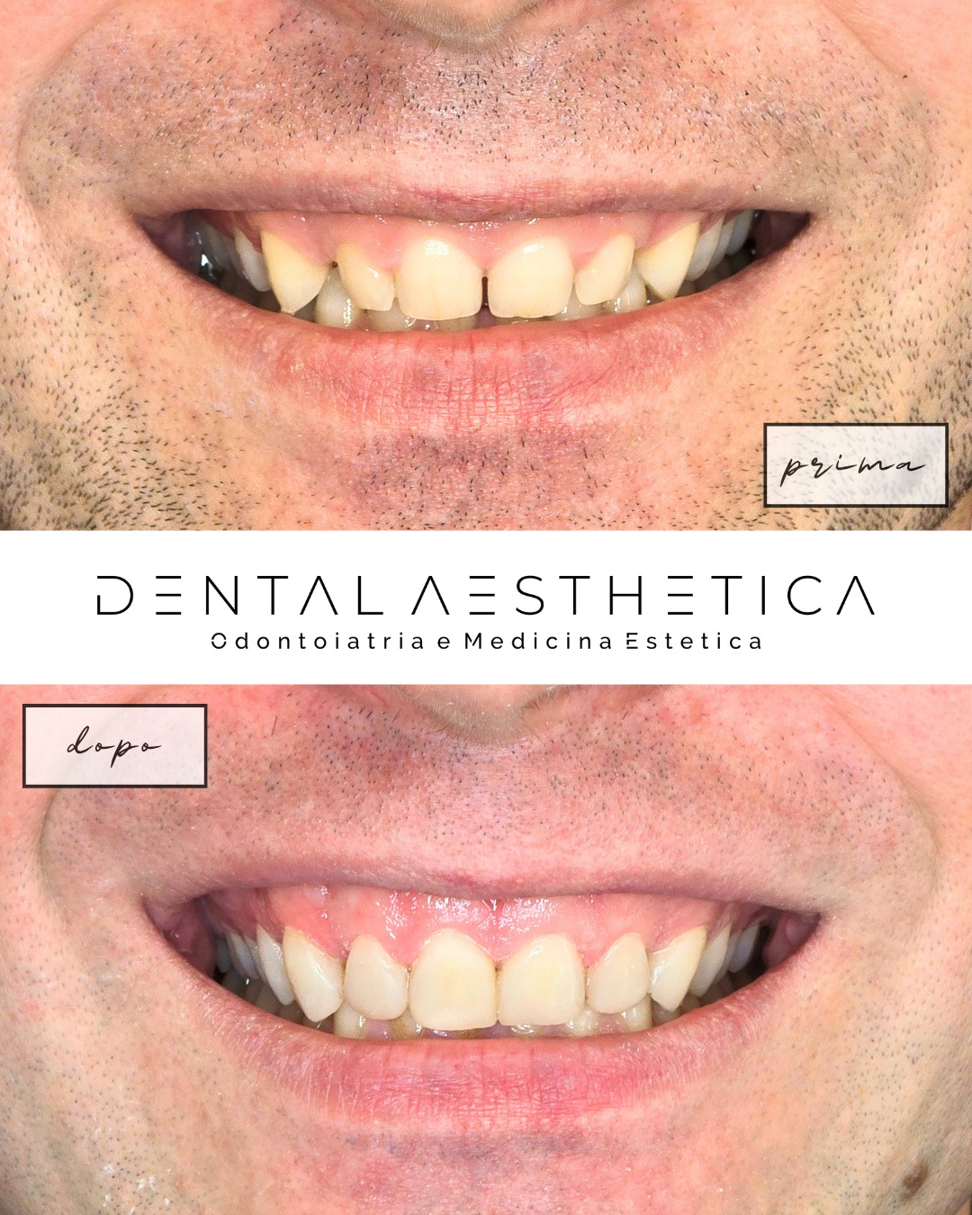 I vantaggi delle ricostruzioni con injection tecnique per migliorare il sorriso 👇🏻
+ Risultato duraturo e definitivo in una giornata
- Nessun dente limato
- Senza bisogno di anestesia
- Meno costoso delle faccette in ceramica
Dental Aesthetica
✨Odontoiatria e Medicina Estetica
📍viale della Grande Muraglia 256, zona EUR-Torrino
📱375 88 47 069