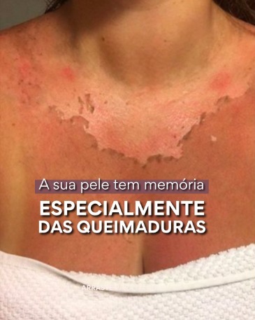 A pele tem memória. E infelizmente, ela não esquece as queimaduras solares severas que sofreu no passado.
Estudos mostram que o histórico de queimaduras com bolhas durante a infância e a juventude aumenta significativamente o risco de melanoma na vida adulta. Isso não é para causar medo, mas para promover a consciência de que o seu histórico solar faz parte do seu perfil de risco.
Dra. Júlia Lóss - Médica Dermatologista Oncológica
CRM 5201085638 RQE 34041
#DermatologiaNiteroirj #DermatologistaNiteroi #PrevençãoDoMelanoma #Melanoma #QueimadurasSolares