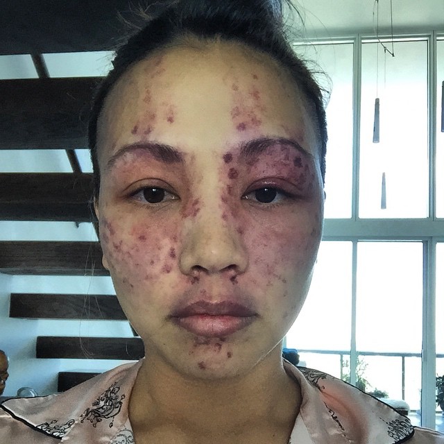 Nov 13 2014Day 3 after the pulse dye laser treatment my skin is slightly burnt feeling but intensely itchy where you see the purple coloring