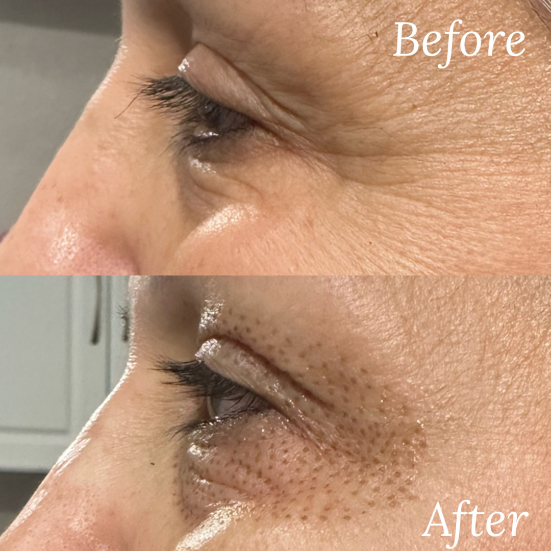 ⚡️Fibroblast Skin Tightening