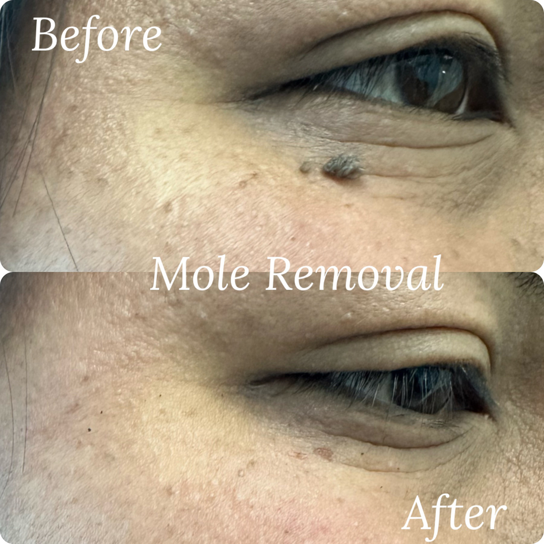 Skin tag and mole removal! These results are immediate! No pain, no downtime!
