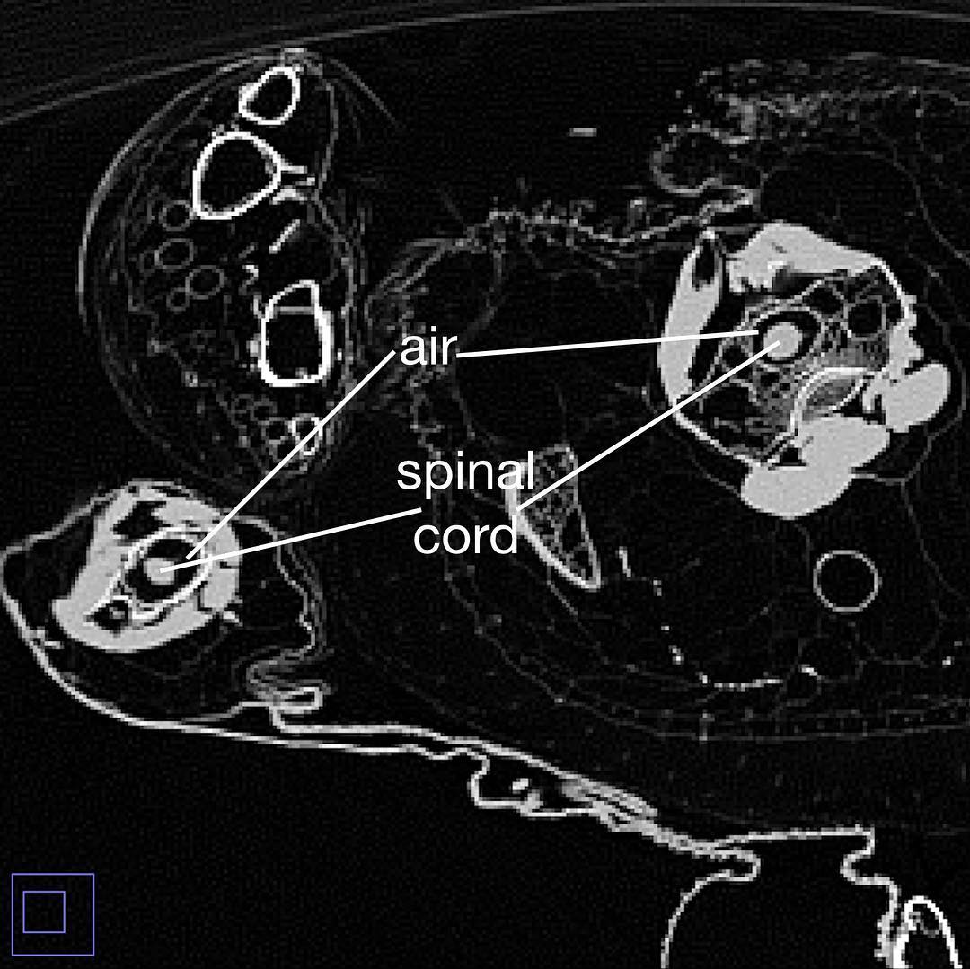 One of my favorite things about being an anatomist are those moments of “Wow, this animal is freaky!” when I see a weird morphology. Lately I’ve been doing a lot of work on bird CT scans studying one of those really weird features: in birds, the respiratory system enters the vertebral canal!
.
You know the holes in your vertebrae that should just be full of your spinal cord? Well, in some birds there is air INSIDE of the vertebrae in contact with the spinal cord. These air spaces are part of the air sac system connected to the lungs (basically it’s like a bunch of balloons inside of birds, distributed throughout their bodies).
.
Sometimes the air spaces in the vertebrae are absent or very small. And sometimes they are big and can even completely encase the spinal cord! That is so freaky. You can see an example in this CT scan of a brown pelican. The spinal cord is totally surrounded by air, and not in contact with bone at all. Color scheme in second image: yellow - vertebral canal, teal - air, magenta - spinal cord.
.
Last month I got to present this research at the Society of Vertebrate Paleontology and Comparative Anatomy annual conference in Manchester, UK. It was soo much fun. The abstract and slides from the talk are available as a preprint on the PeerJ website (a scientific journal) if you search for my name. Yay for making science available to everyone!
.
#bird #pelican #ctscan #deadstuff #anatomy #freaky #science #scicomm #livingdinosaur #openaccess #comparativeanatomy #svpca2018