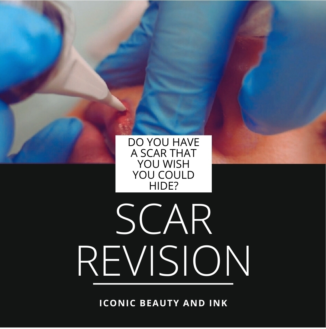 ๐ฆ Do you have scars that you would like to camofluage?โโโโโโโโ
Paramedical Tattooing can help!โโโโโโโโ
โโโโโโโโ
๐ฆ Stretchmarks, Burns, Scars, Skin Grafts, Surgical Scars, Self Harm Scars, and other skin traumas can be concealed by Skin Camouflaging.โ โโโโโโโโ
โ โโโโโโโโ
๐ฆ This can help you get rid of the painful reminders of your past and help you feel more confident!๐โโโโโโโโ
โโโโโโโโ
.โโโโโโโโ
.โโโโโโโโ
.โโโโโโโโ
.โโโโโโโโ
#Scars #camouflage #Paramedical #Tattoo #artist #tattooartist #Skin #burns #scarcamoflauging #tattoocoverup #Florida #transformation #floridaartist #facelift #faceliftscars #burncoverup #southflorida #fortlauderdale #parkland #pmu #pmuartist #feelbetter #byescars #self-harm #Bocaraton #confidence @iconicbeautyandink