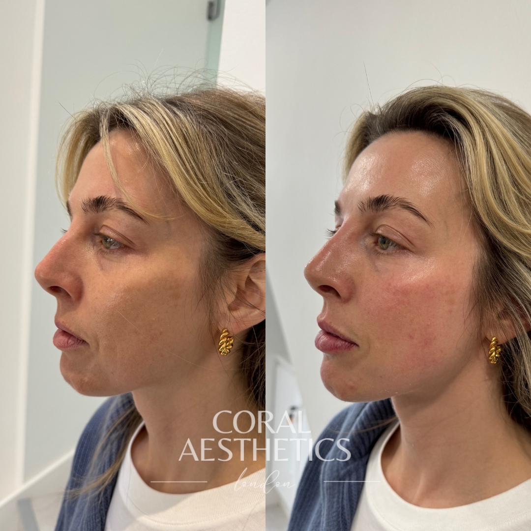 Profile balancing typically involves subtle tweaks to the nose, chin and lip using dermal fillers!
Select our Harmonisation Protocol or simply book in for a consultation to plan your treatment today.
📍London | Essex | Kent
👩🏽⚕️Experienced Nurse Prescriber
⭐️5 Star Reviews
💻Online Booking Open
#LipFillerNatural #AdvancedLipTechniques #LipTenting #ProfileBalancing #DermalFillers #BestLipFillerClinicLondon #Nosefiller #ChinFiller #AestheticClinicLondon #EastLondonAesthetics #KentAesthetics #Ashfordclinic