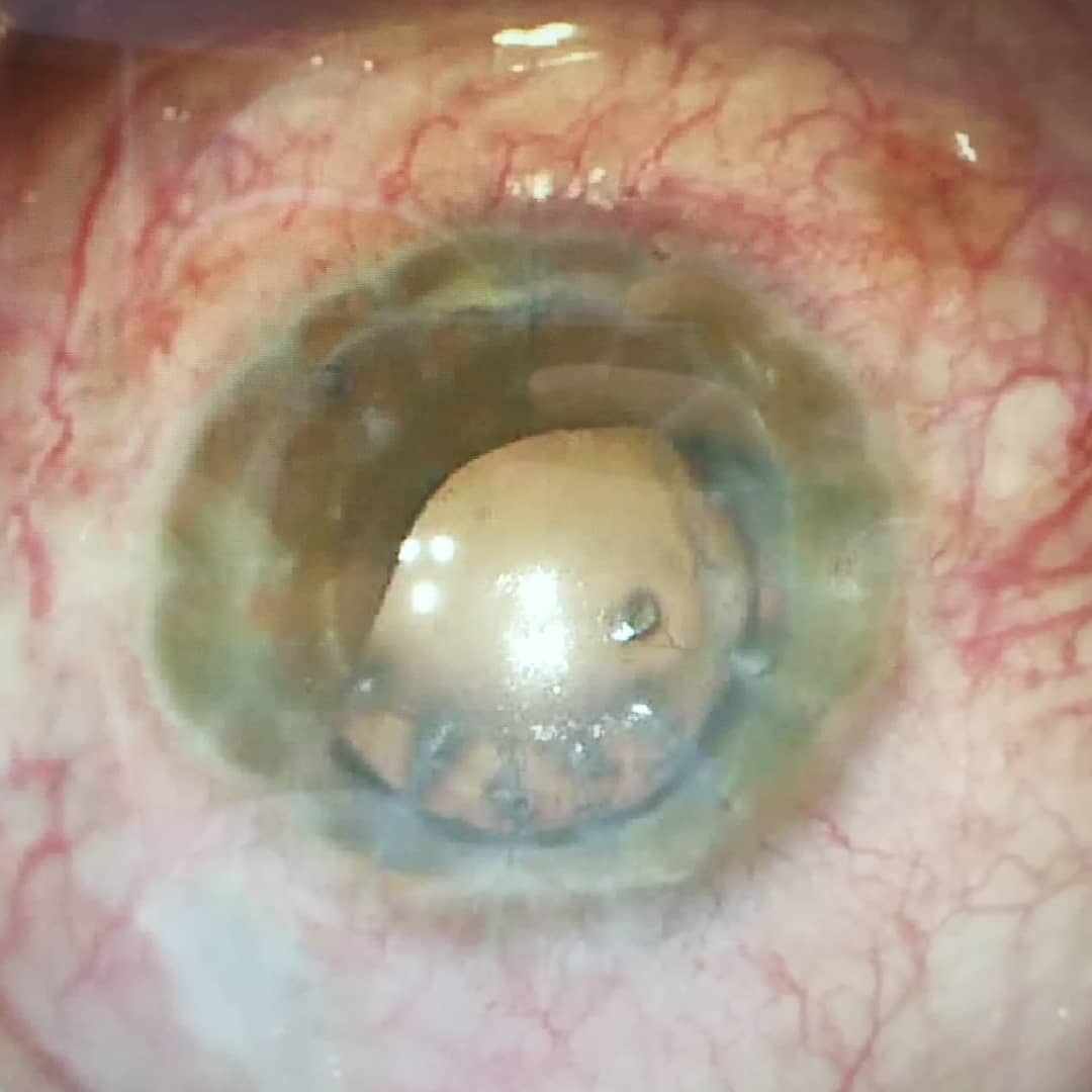 Traumatic partial aniridia treated with Human Optic artificial iris implantation. Preop vs post op. #artificialiris #humanoptics #eyesurgery