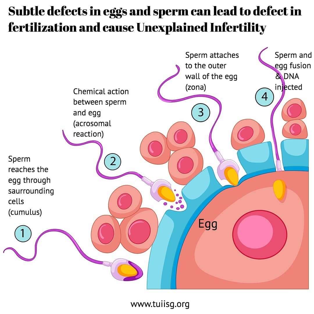 Sperm meets the egg in the fallopian tube. This meeting is not random. Complex chemical changes and signals are essential for sperm-egg communication.
Subtle defects in oocyte and sperm can lead to defective fertilisation: • Sperm defects like abnormal acrosomes can result in poor or no zona pellucida binding. The sperm fails to attach to the egg leading to no fertilisation. • Even a normal semen sample may include sperm with altered genetic material. High levels of sperm DNA fragmentation can lead to reduced fertilisation and increased miscarriage rate. • Failed egg activation can lead to failed fertilisation even if the sperm DNA has been injected into the egg.
For more visit www.tuiisg.org
#fertility #ttc #pregnancy #sperm #male #Gynaecologist #clinic #UnexplainedInfertility #unexplainedinfertilitysucks
#unexplainedinfertilityttc
#unexplainedinferility #infertilitysupport #infertilitycommunity