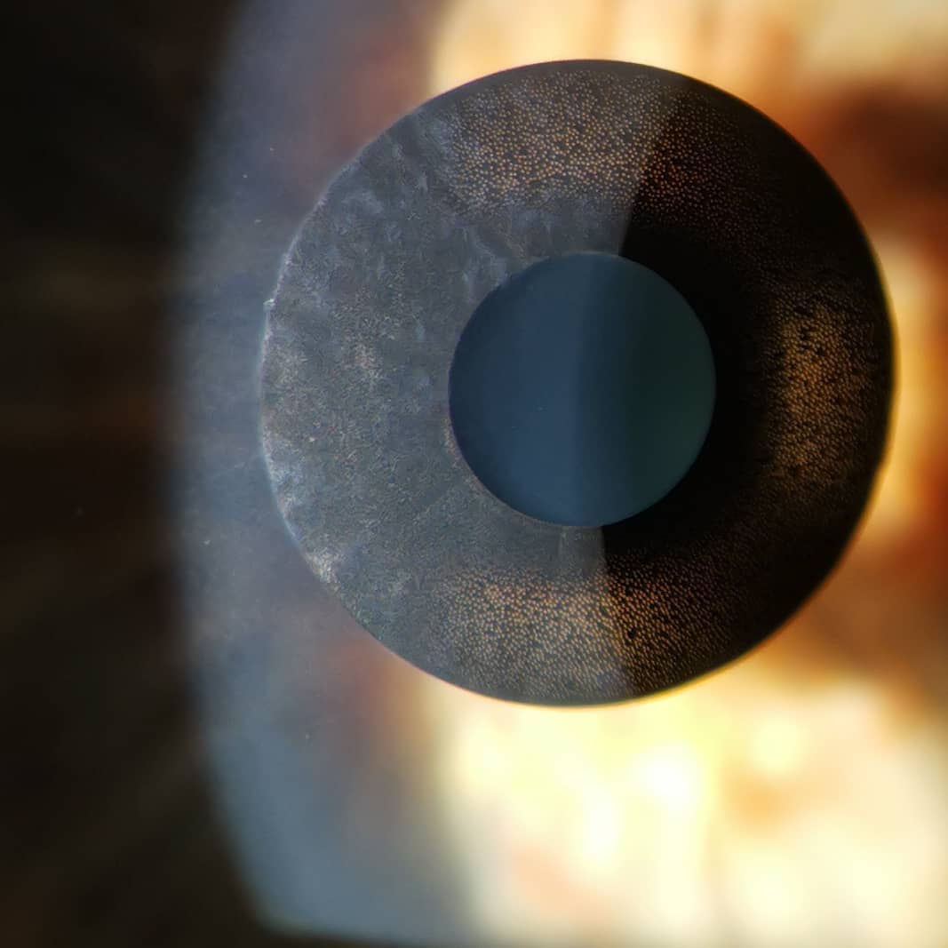 #presbyopia #kamrainlay #10yearslater #20/20vision