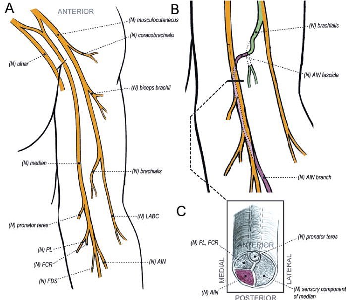 Just completed my first peripheral nerve fellowship case - a nerve transfer at WashU for restoration of hand function in a patient with a cervical spinal cord injury. Looking forward to a good outcome.