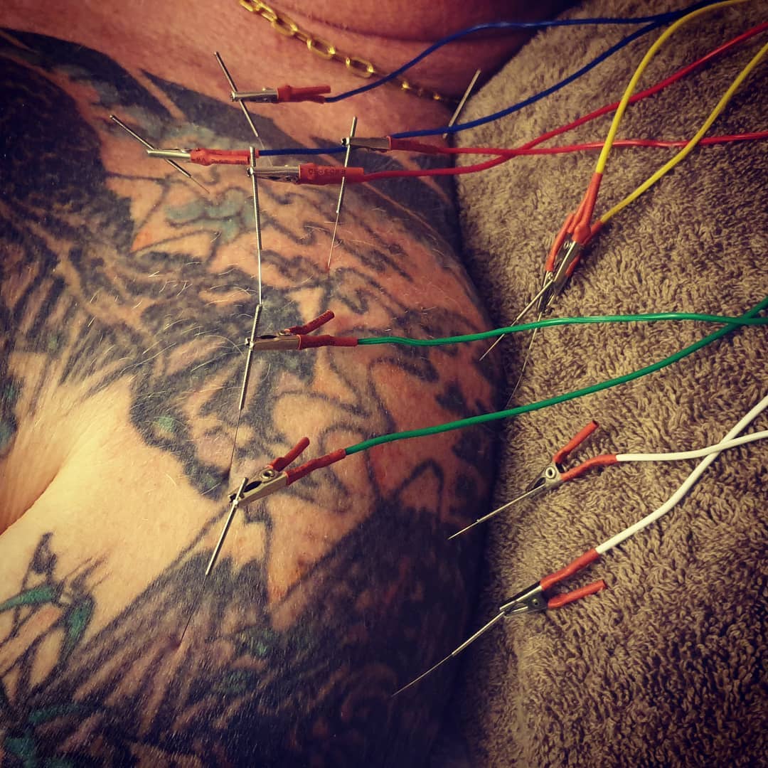 If you have any kind of shoulder pain, diagnosed or not, and you have not yet found relief, acupuncture is a safe procedure that may help to treat your pain. Acupuncture works to reduce inflammation and promote the body's own pain relieving substances.
#acupuncturelife #acupuncturetherapy #acupunctureneedles #acupuncturist #acupuncture #acupuncturetreatment #acupuncturedoctor #acupuncturepoints #acupunctureworks #acupuncturerocks #acupuncturebrisbane #shoulderpain #shoulder #bursitis #electroacupuntura #electroacupunture